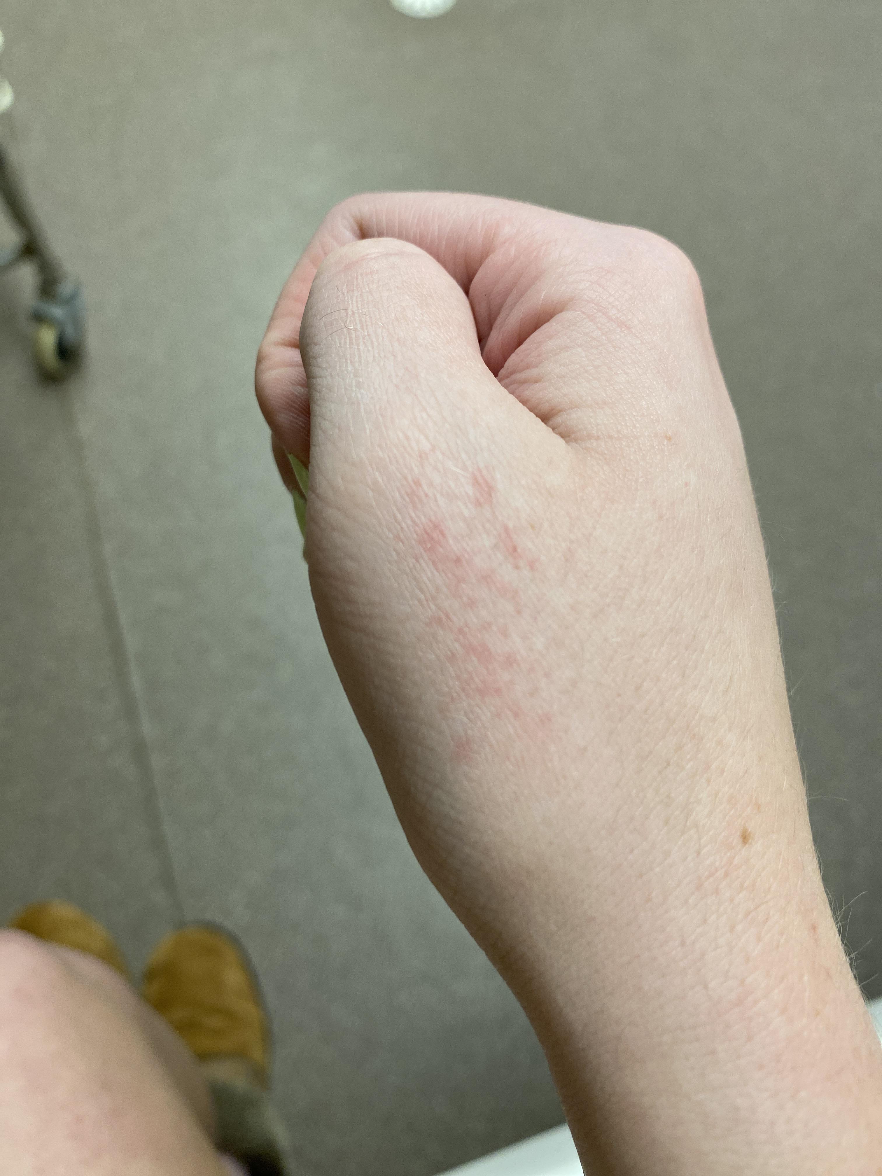 from accutane? (day 12)…but also have been dealing with an injury to