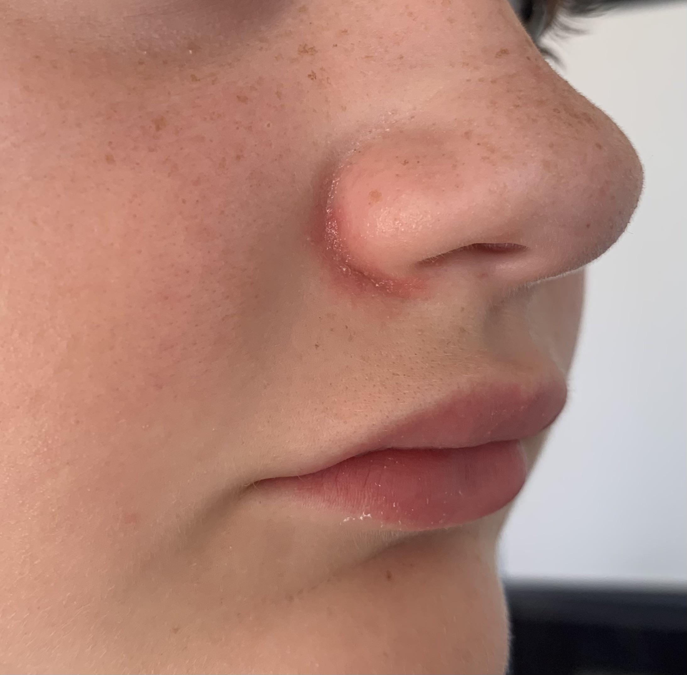 [product request] dry, sore skin around nose. Have been using epaderm