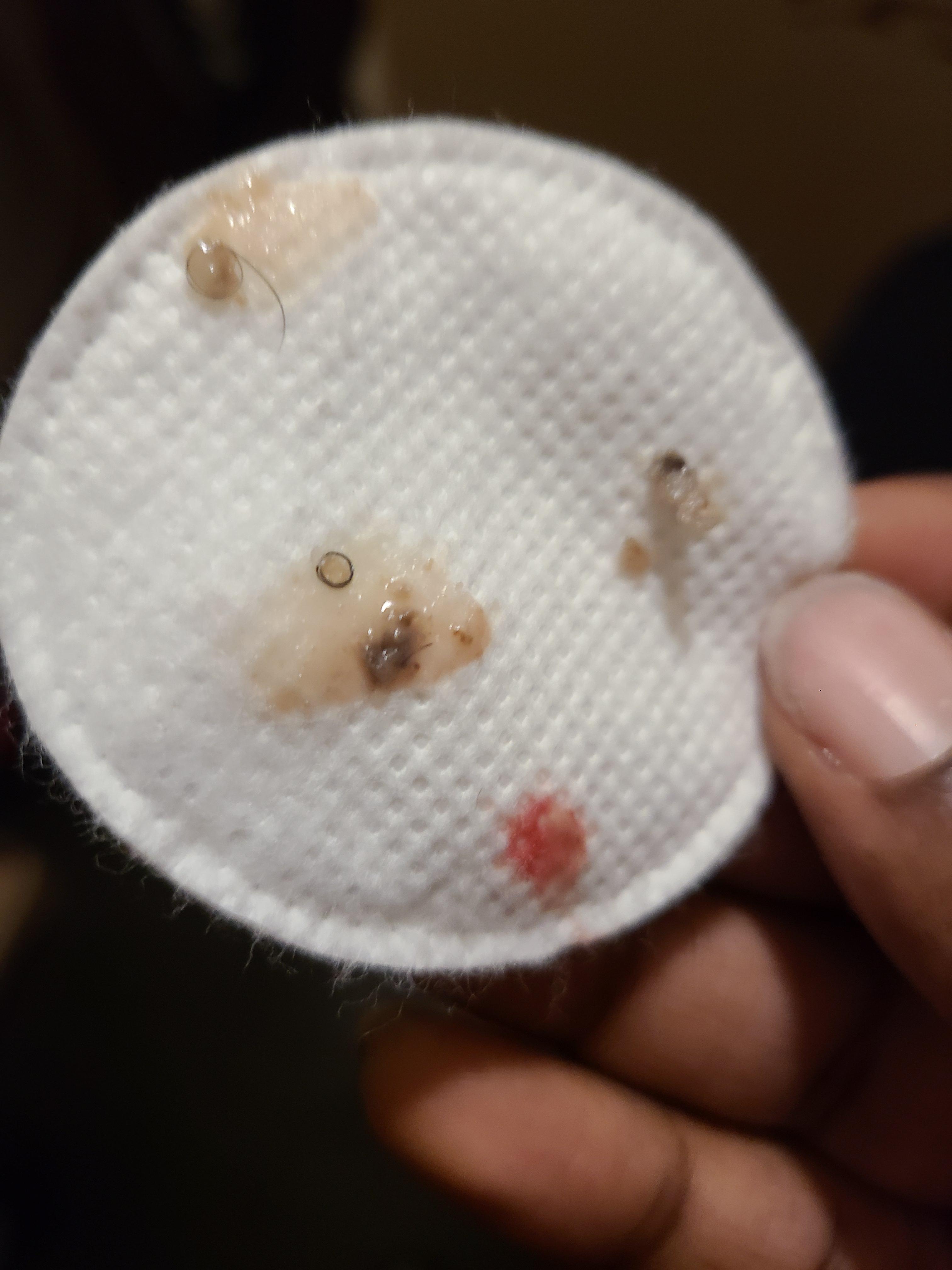 contents of a boil on my inner thigh that turned out to be an ingrown