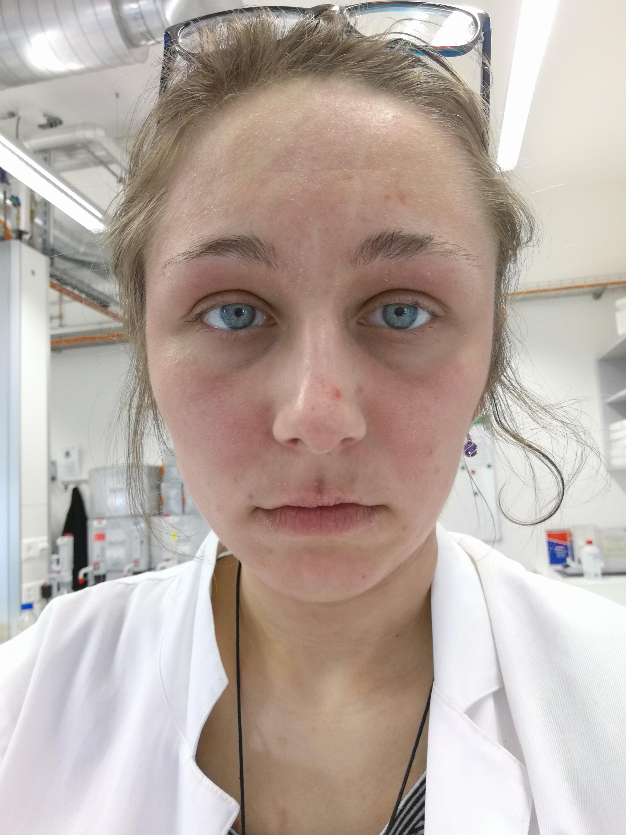 Dry itchy skin in the face / on neck, I am not allergic to anything