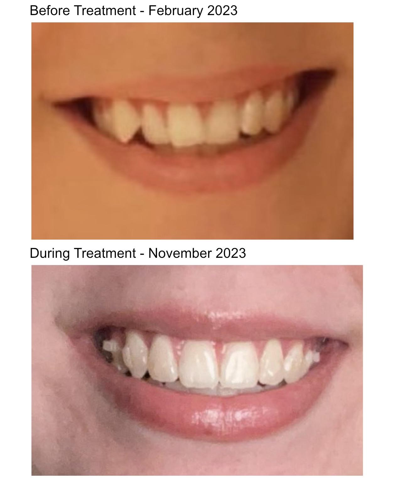 Pain Relief? r/Invisalign