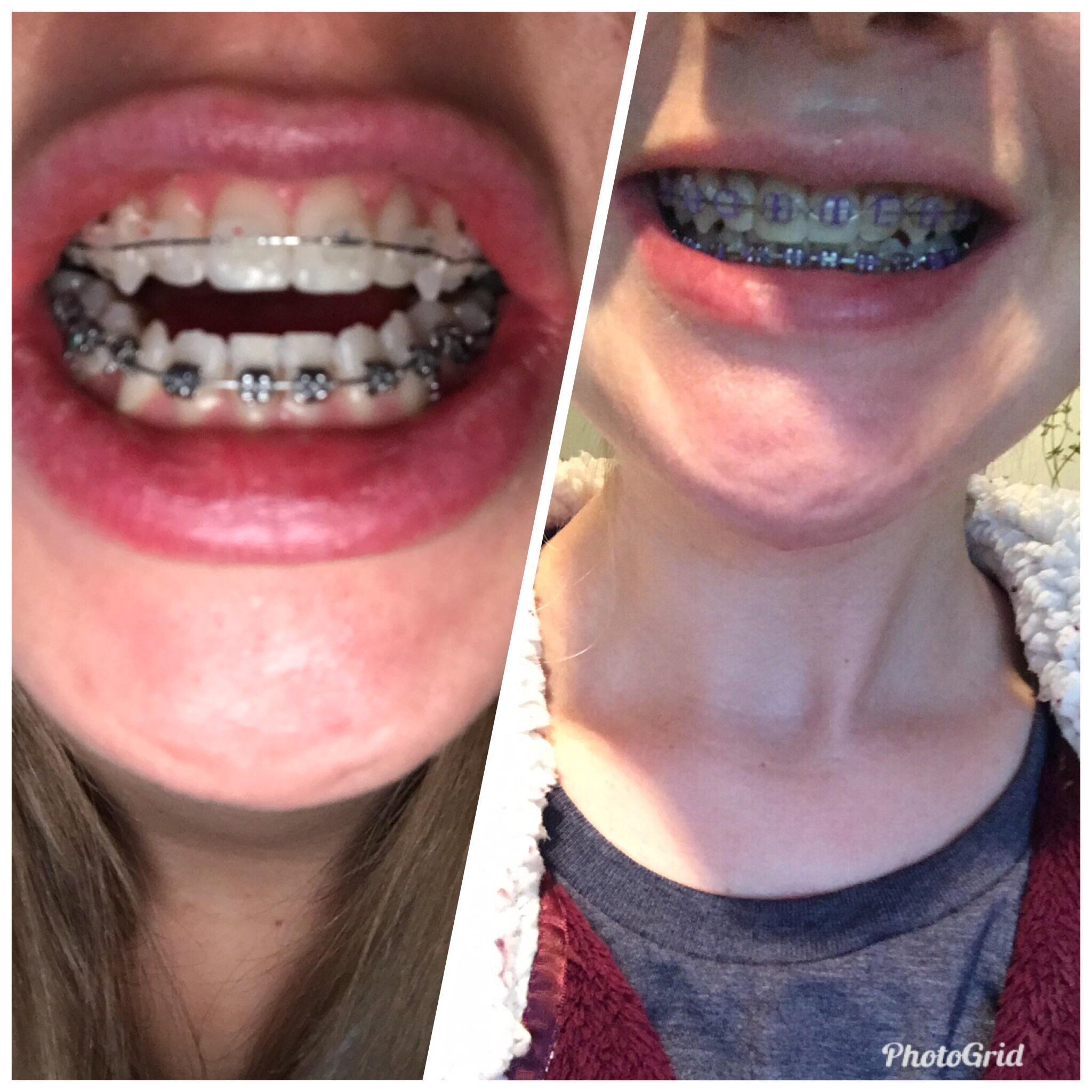 First day of braces vs. 8 months of braces+double jaw surgery r/braces