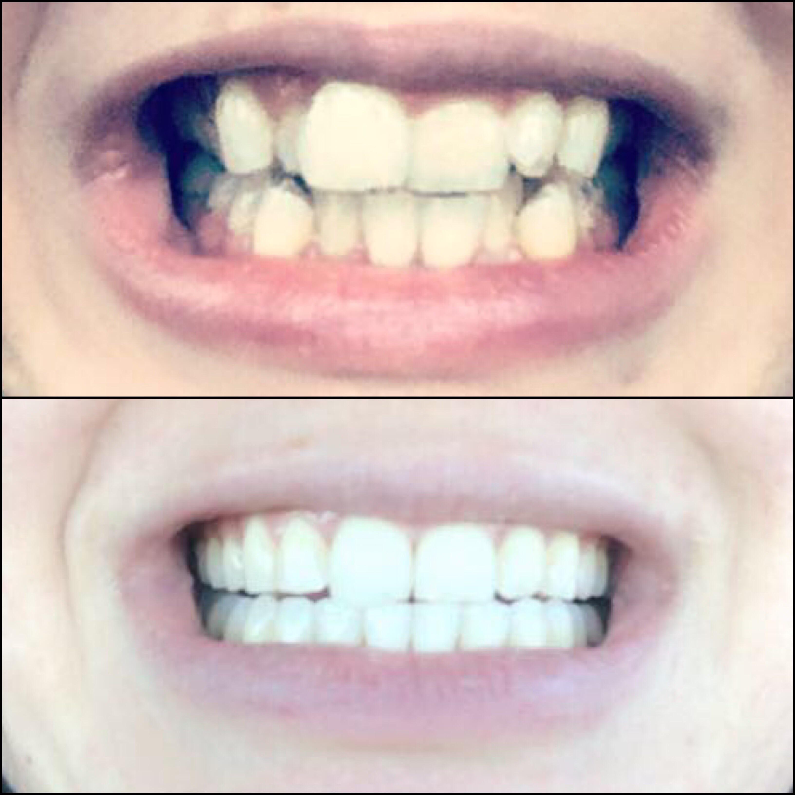 2 years + 2 months, 42 trays + 16 refinements later, I’m finished