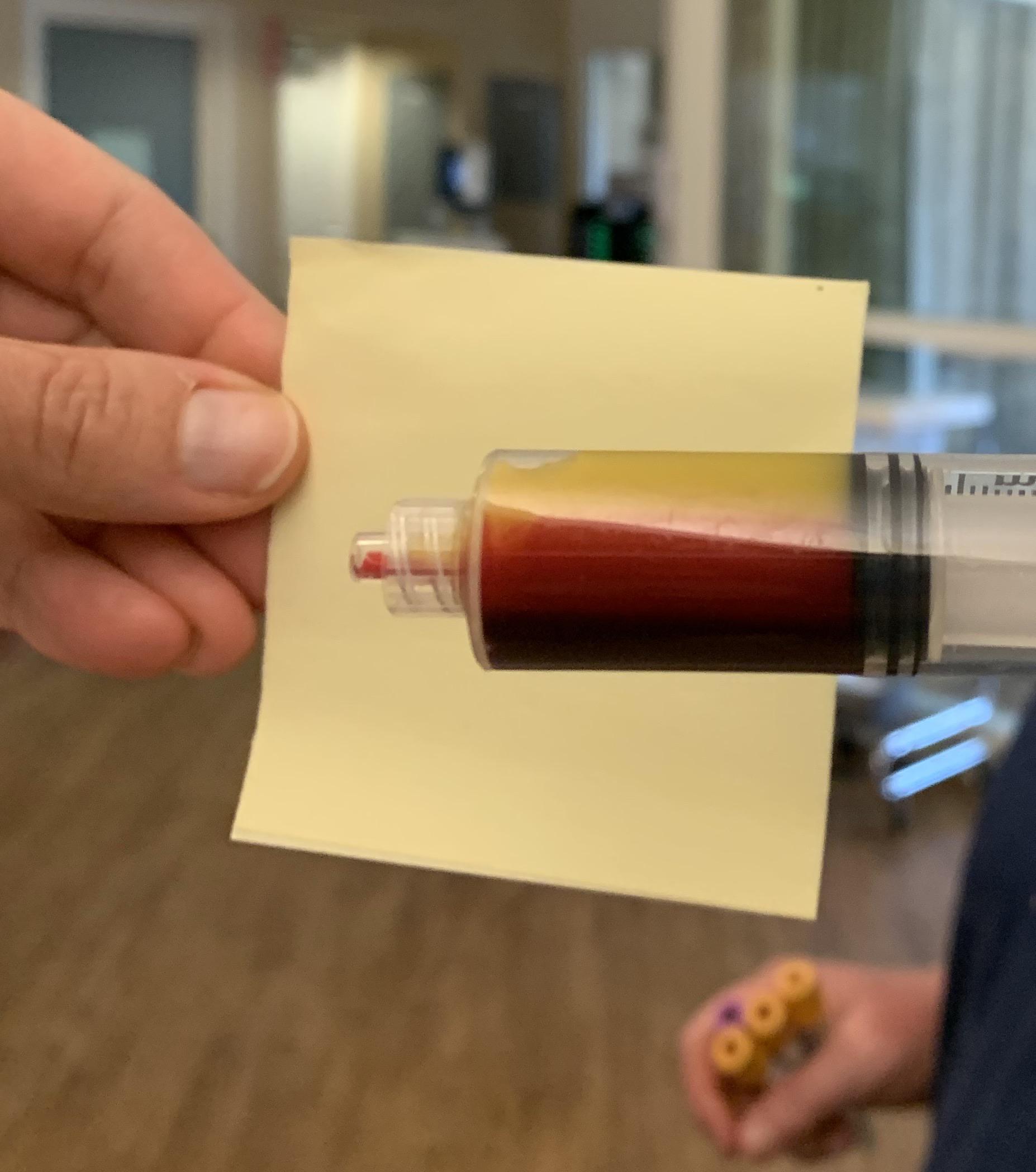 Patient with a blood TG level of 994 r/medicine