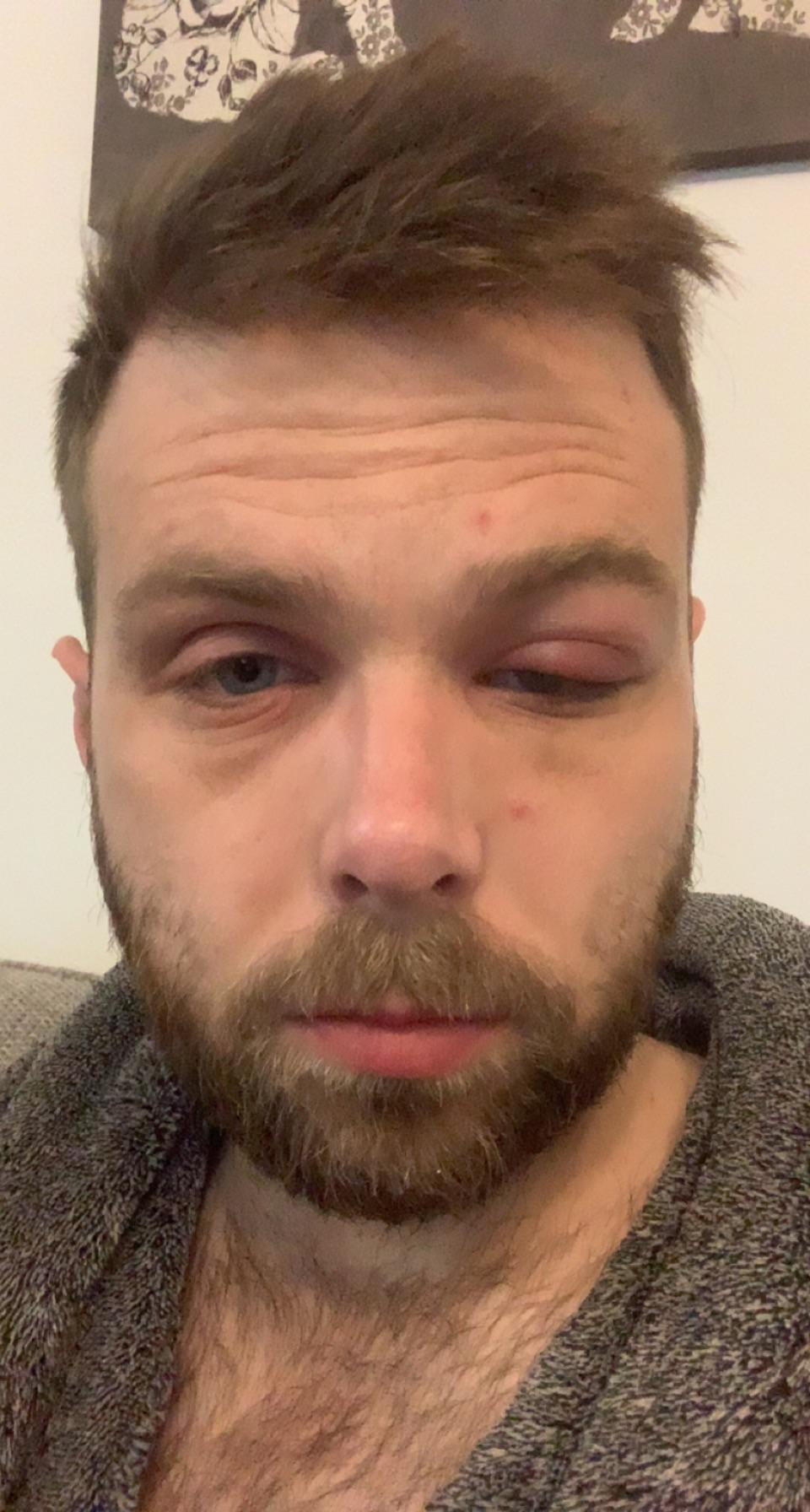 Update Eye swollen again. This is the 6th time this has happened in