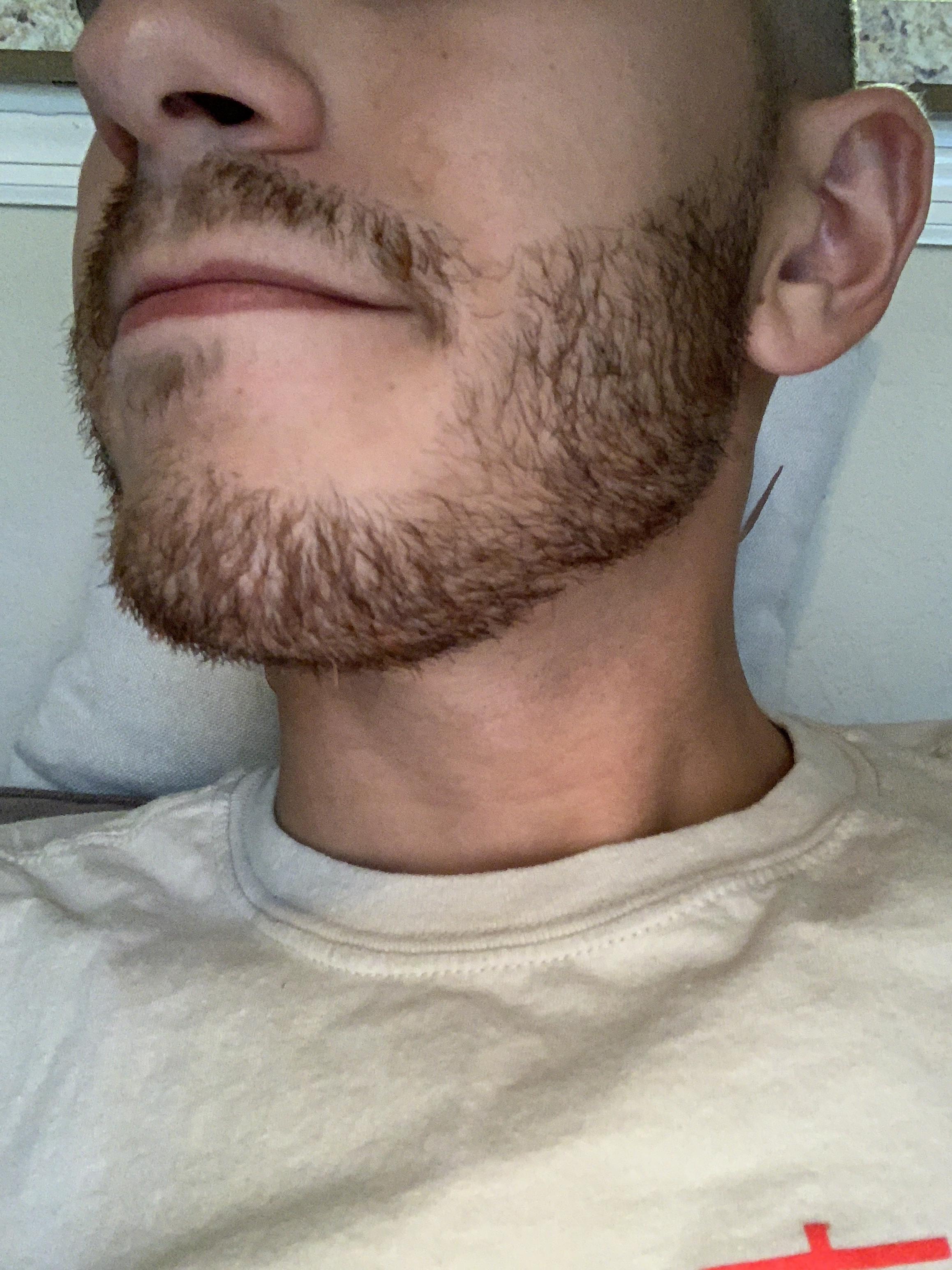 Patchy beard. Will it fill ? r/beards