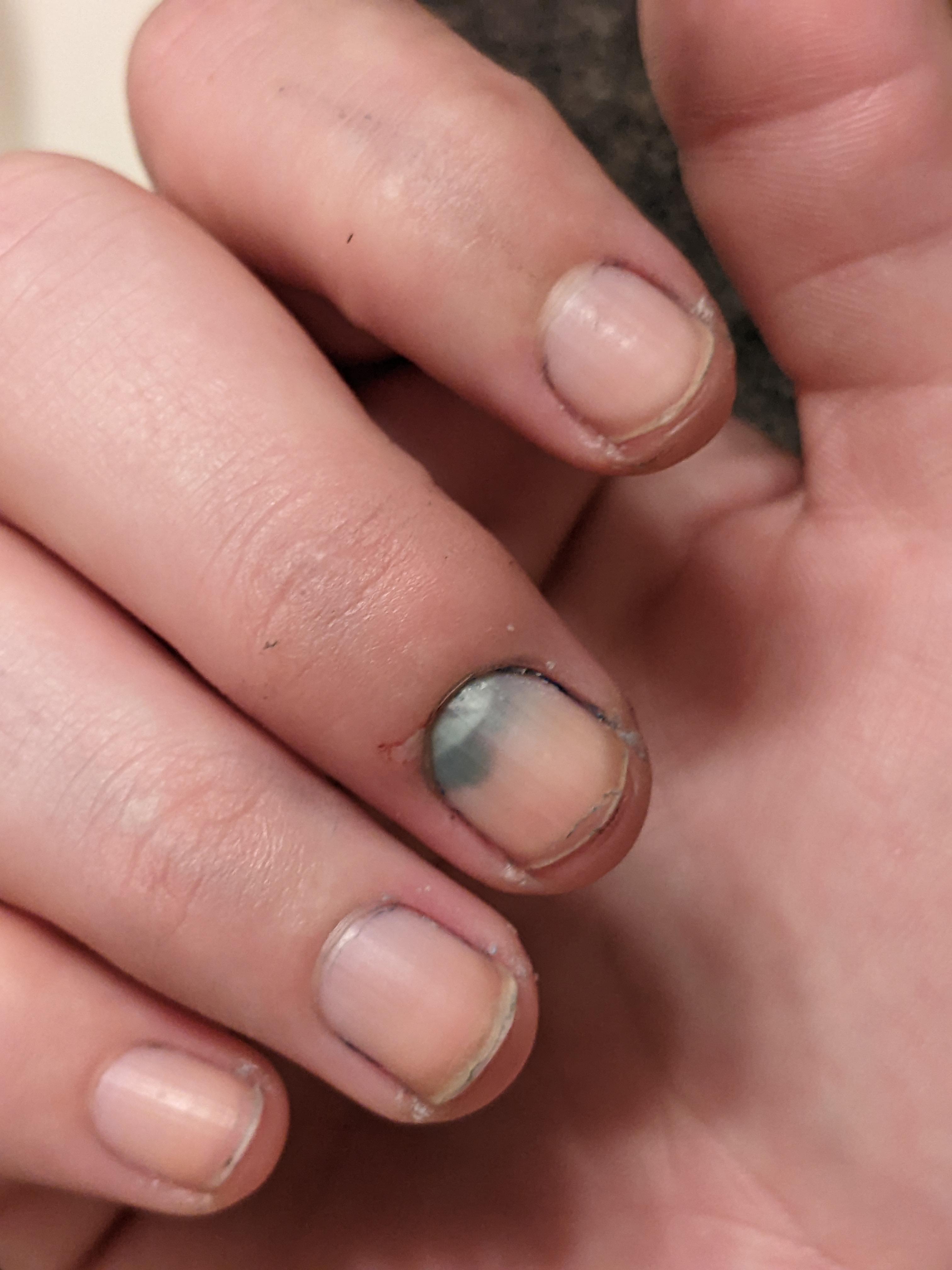 Do you think my fingernail will eventually fall off? Slammed my finger