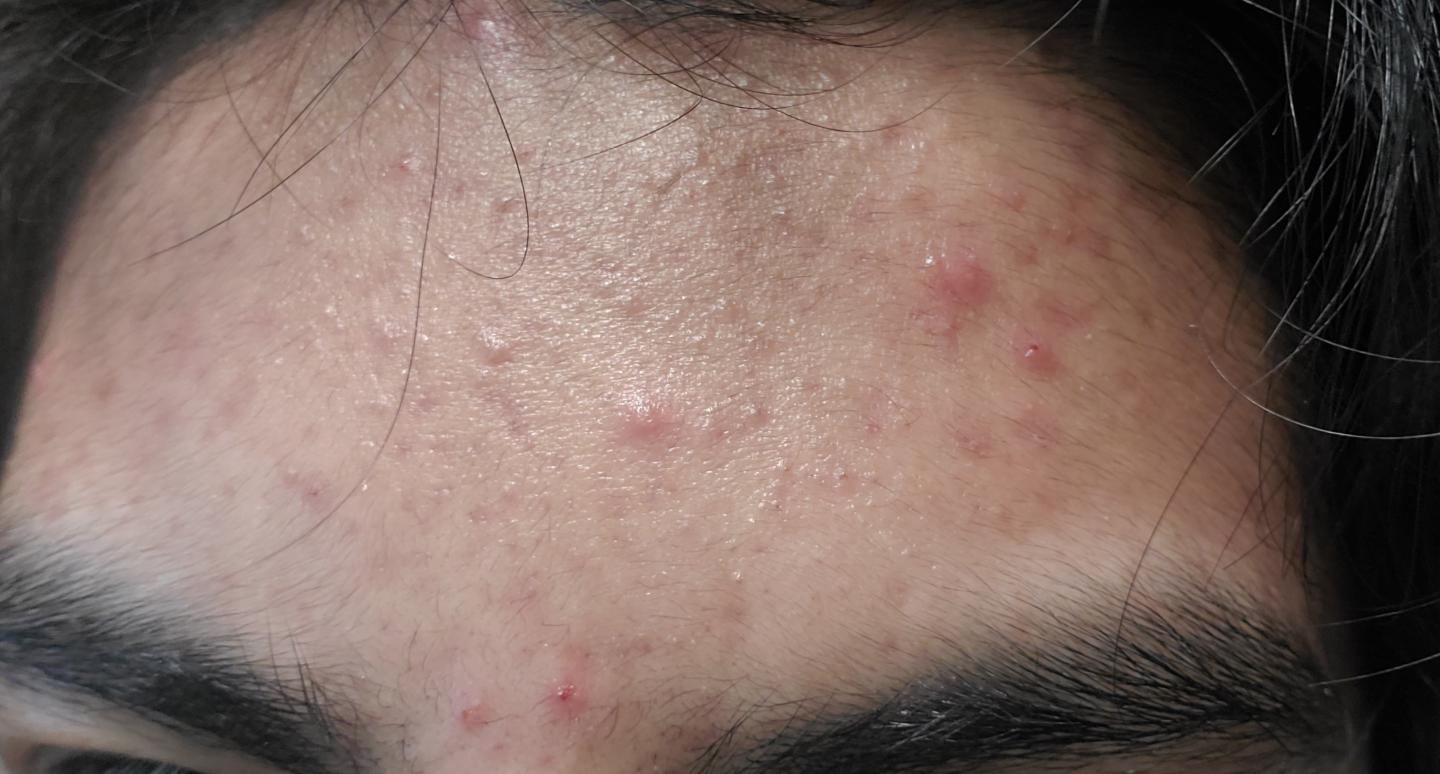 Could my hair in my face be causing/worsening my forehead acne, and if