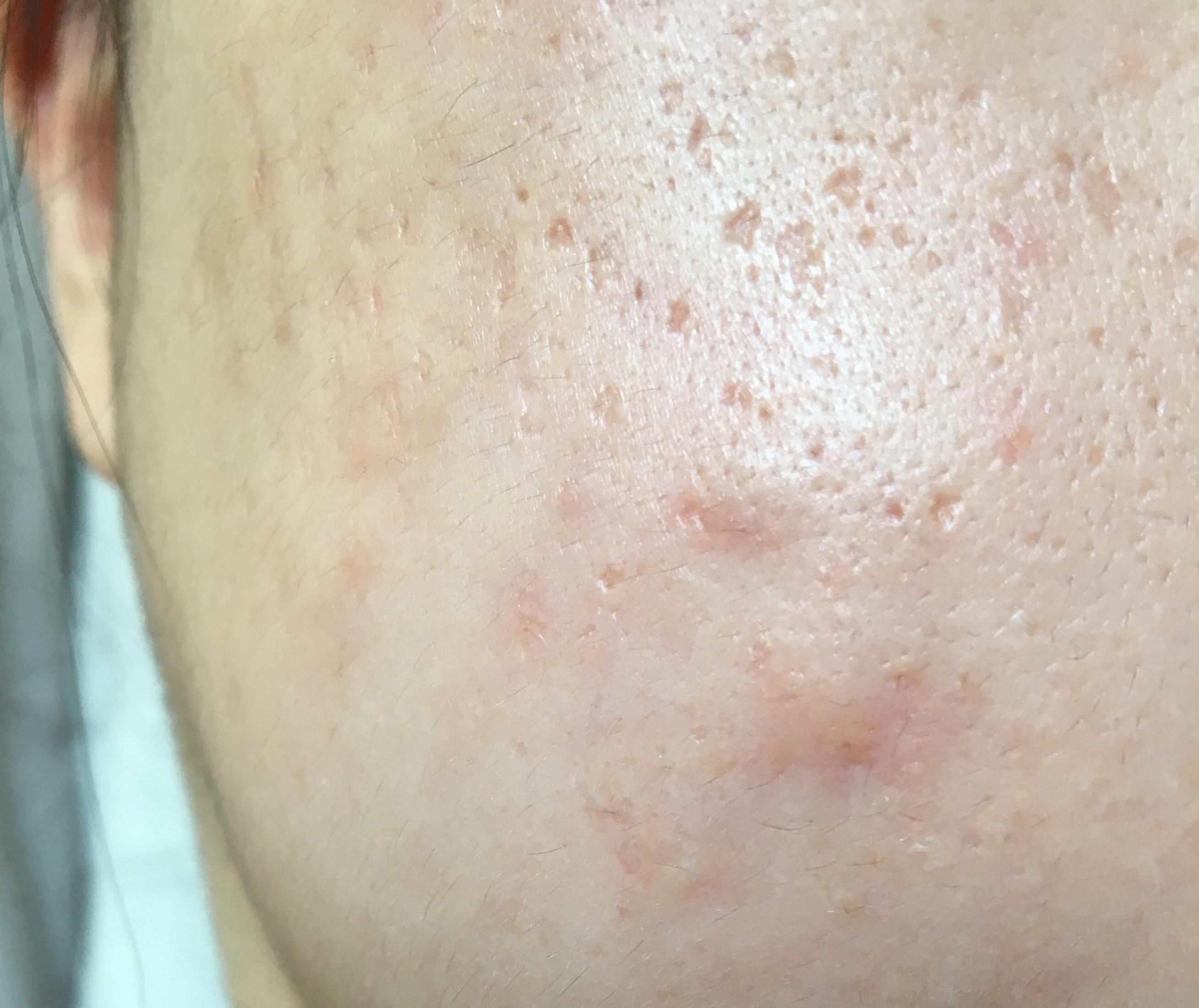 Nodular Acne