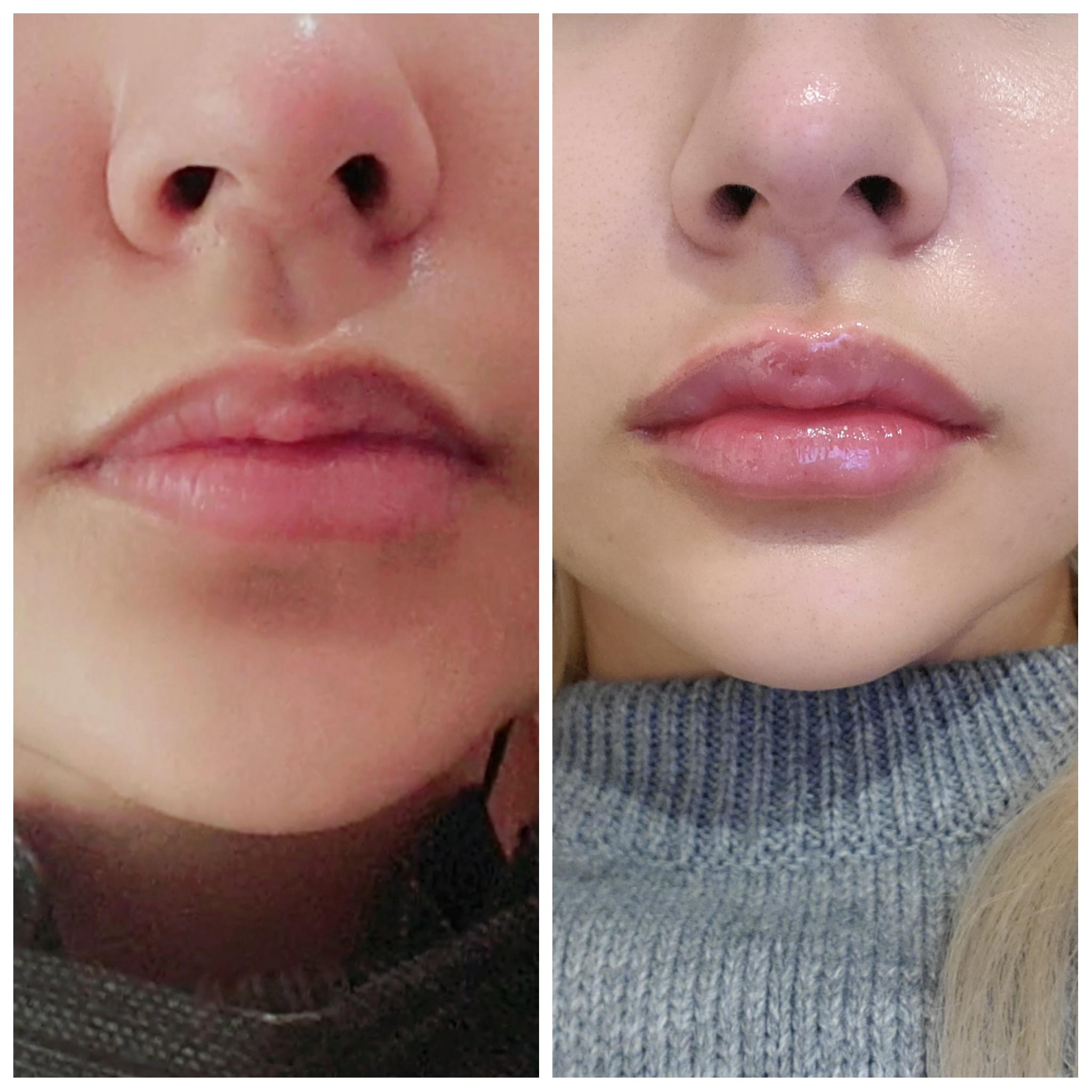 Lip filler opinion? I went to get lip fillers in korea and they gave me