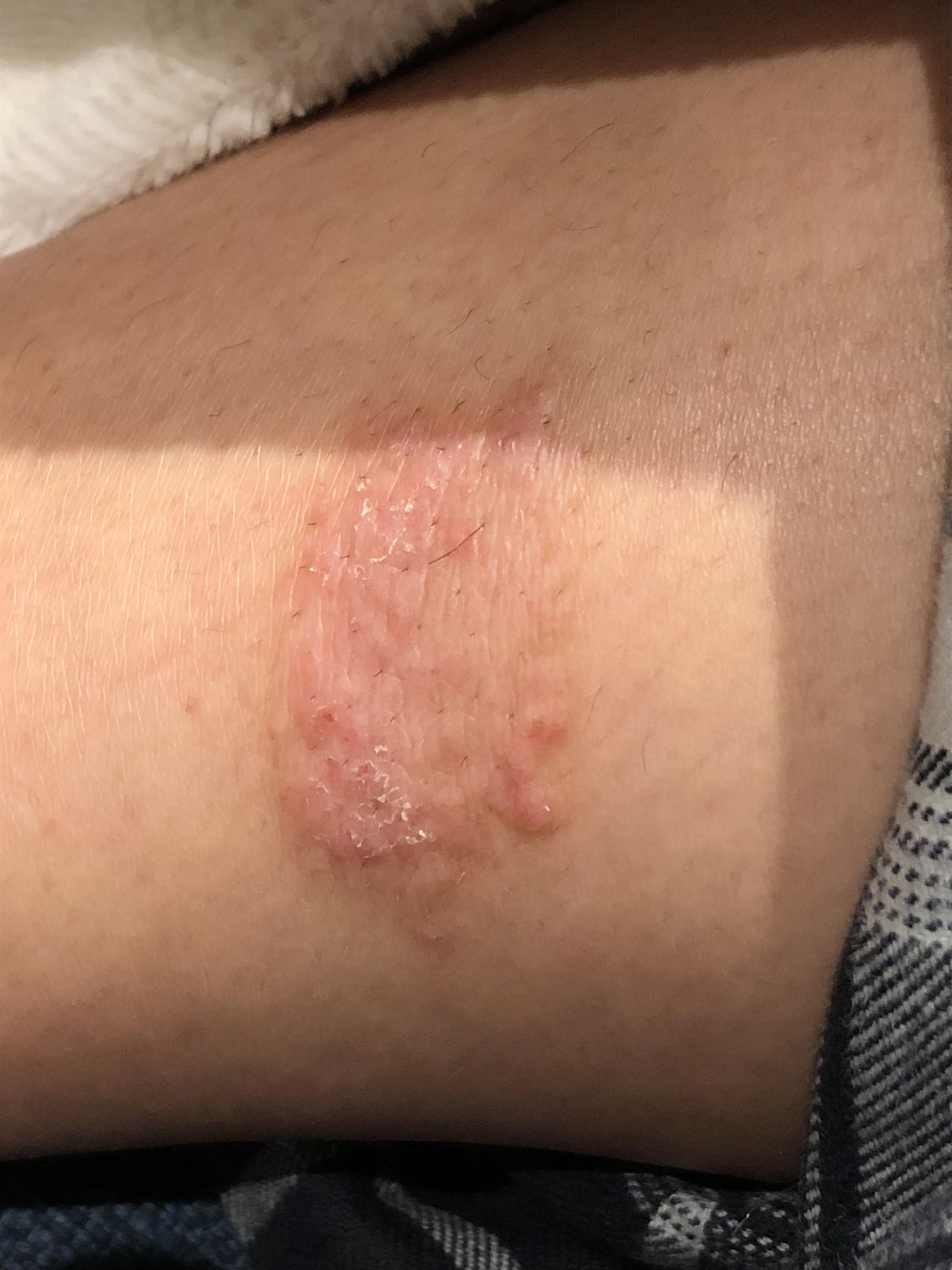 Is this nummular eczema or ringworm? Located on side of