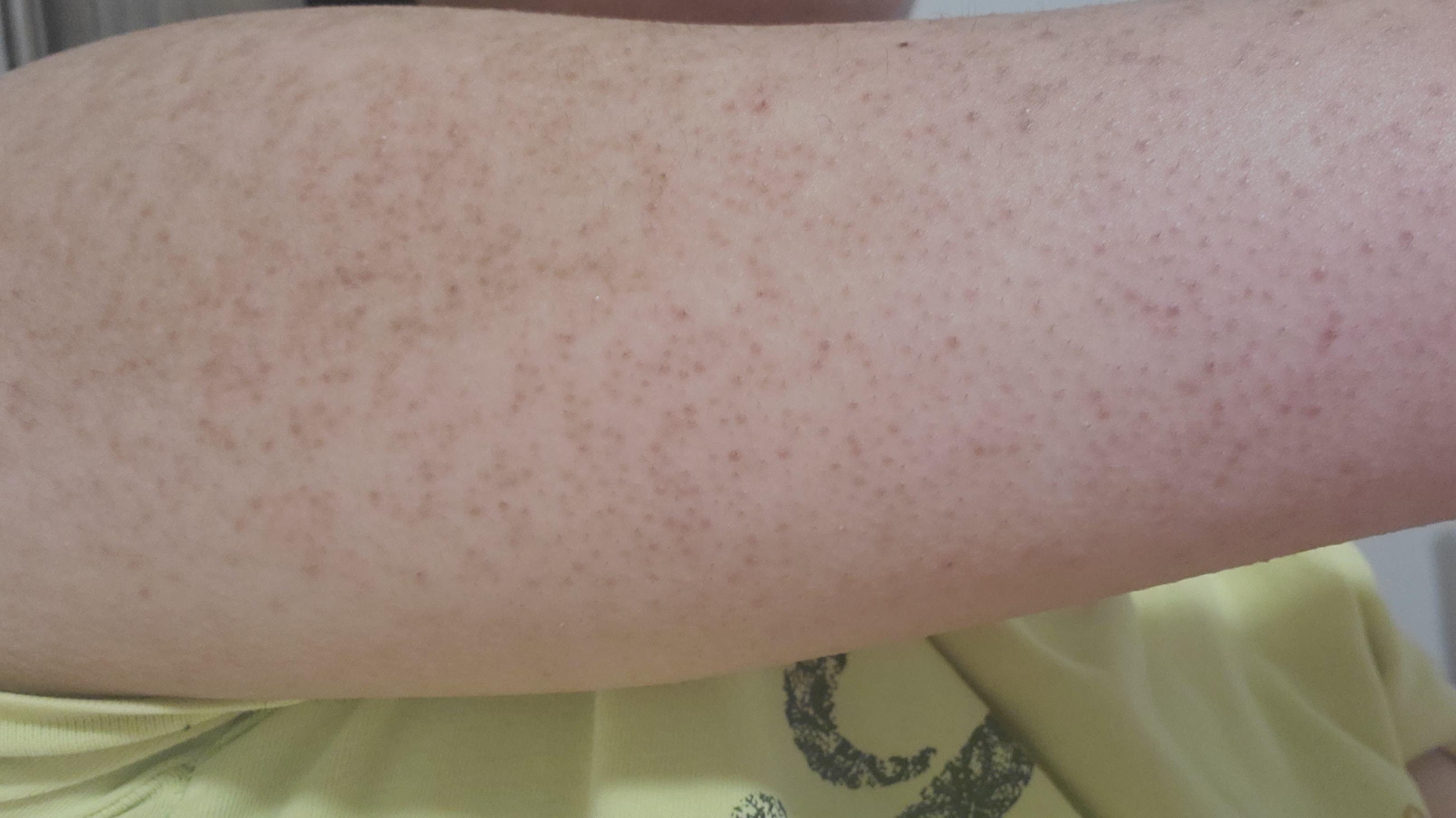 So I have keratosis pilaris and I went to my dermatologist in August
