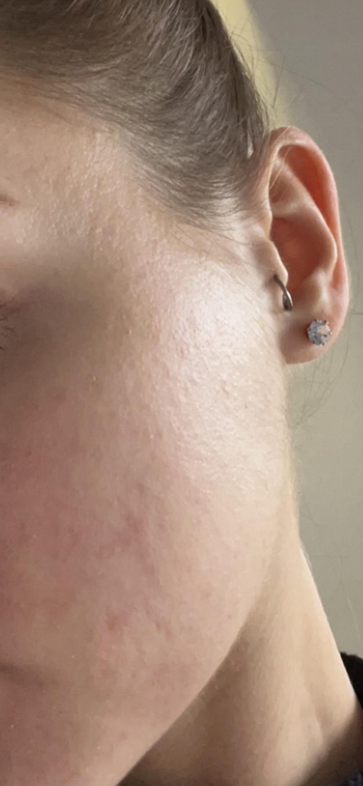 What does this texture look like? Exfoliating makes it worse r/Fungalacne