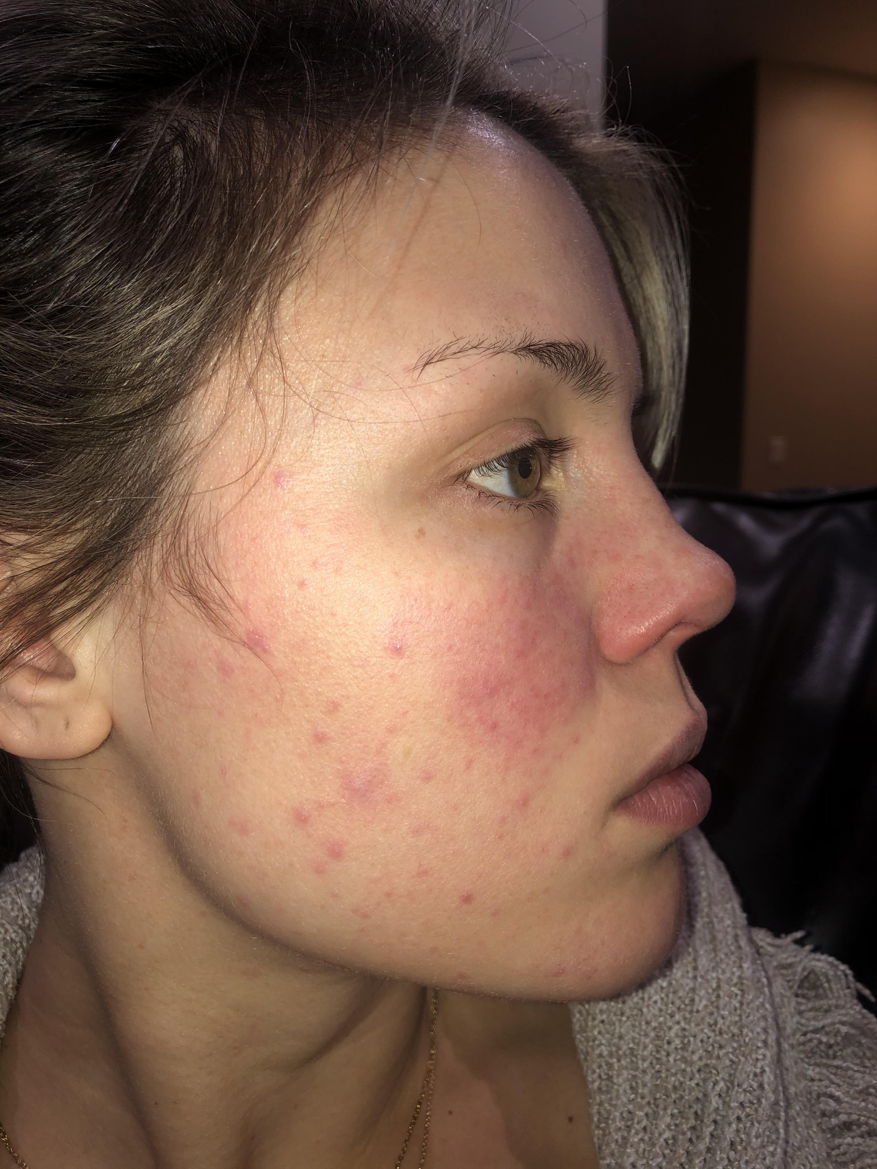 Gluten Rash On Face