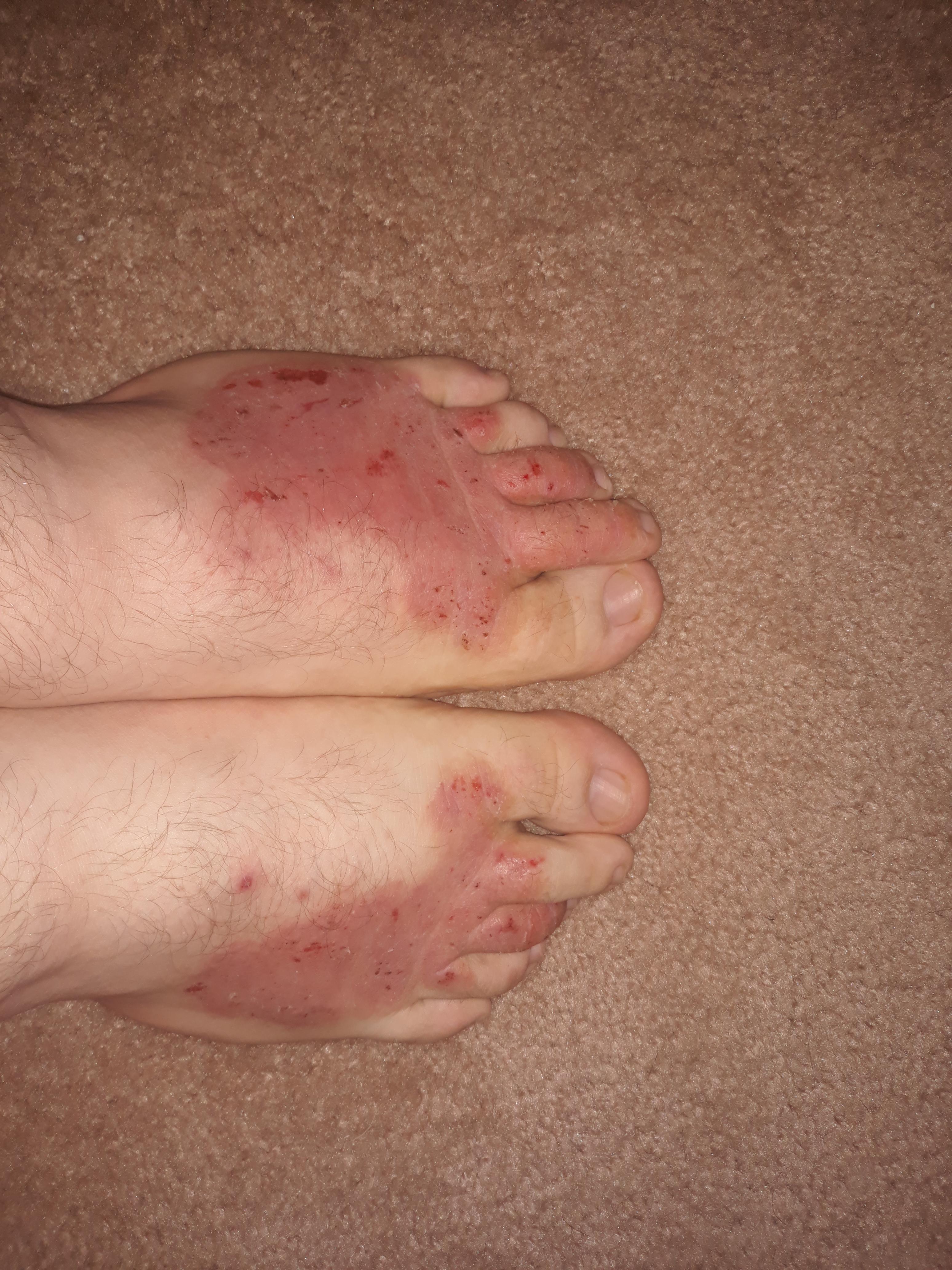 Dry, itchy, painful, red skin on top of feet help? r/medical