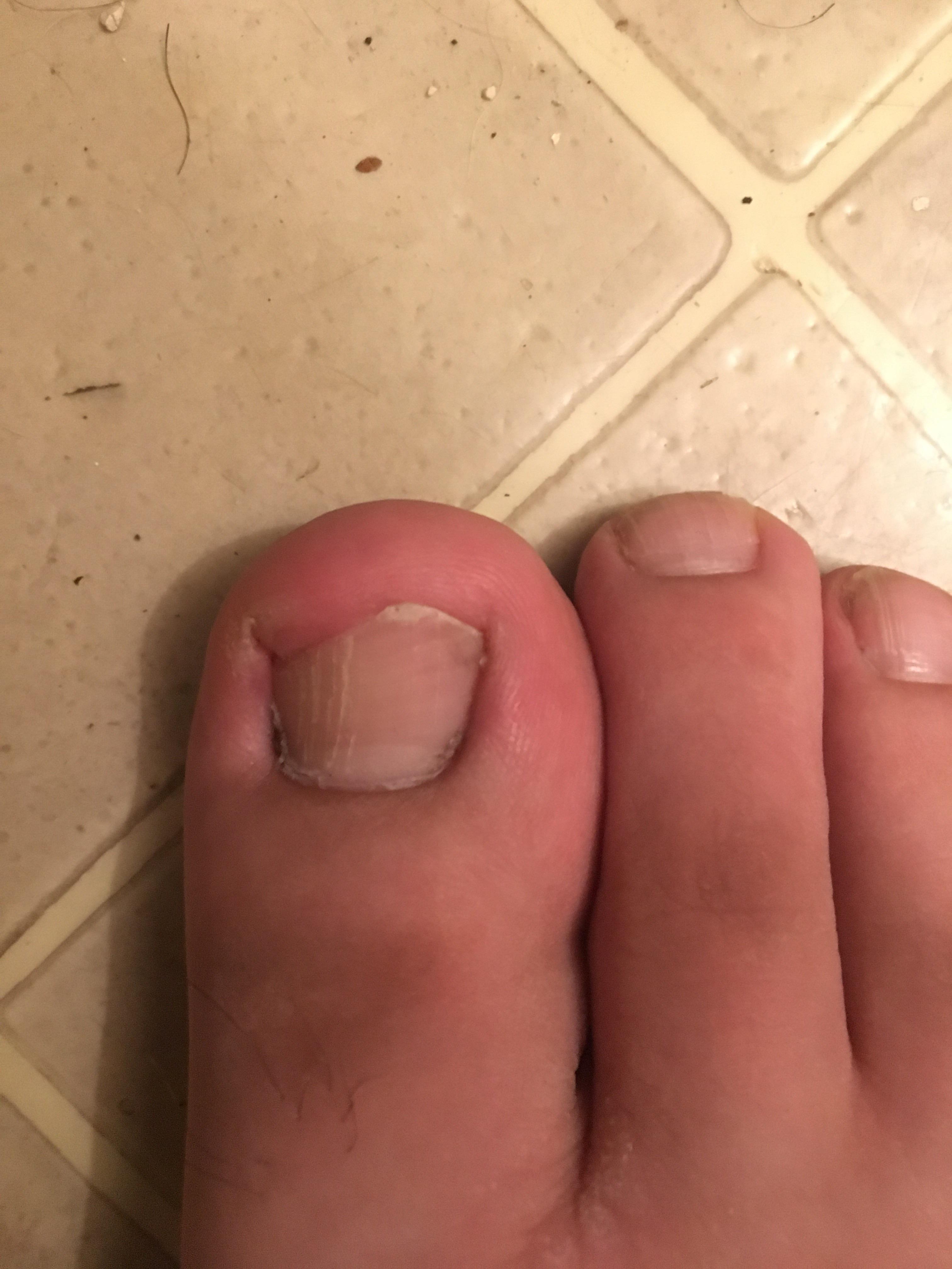 I cut my toe nail too short a few days ago. The nail bed has stopped