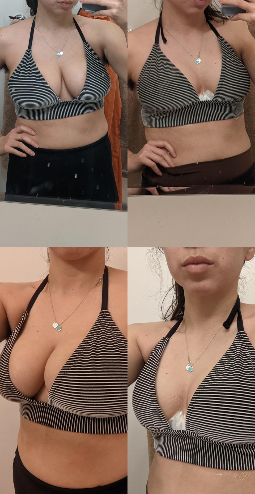 Night before surgery & 9 days post op r/Reduction