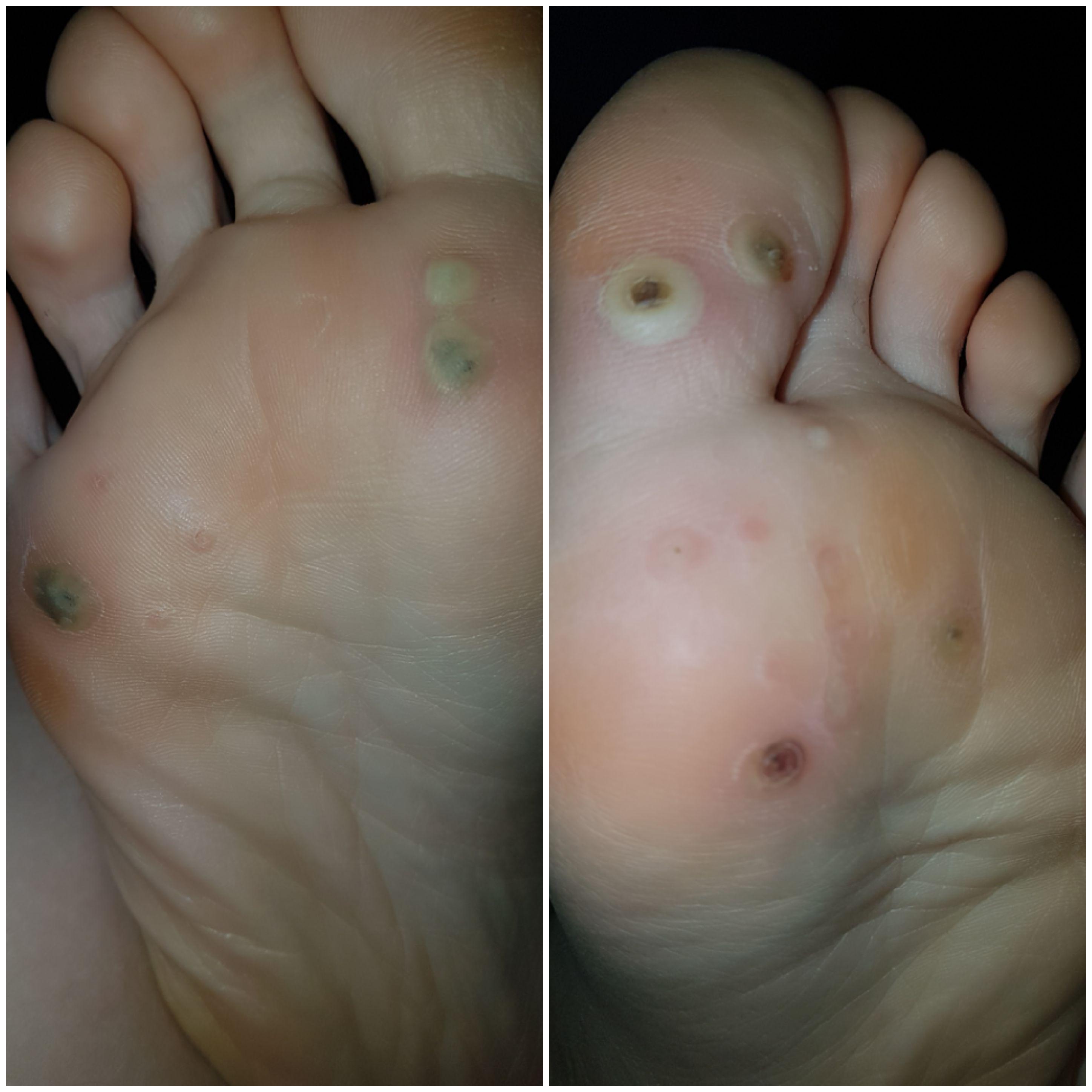 My plantar wart situation before one of them finally fell off after