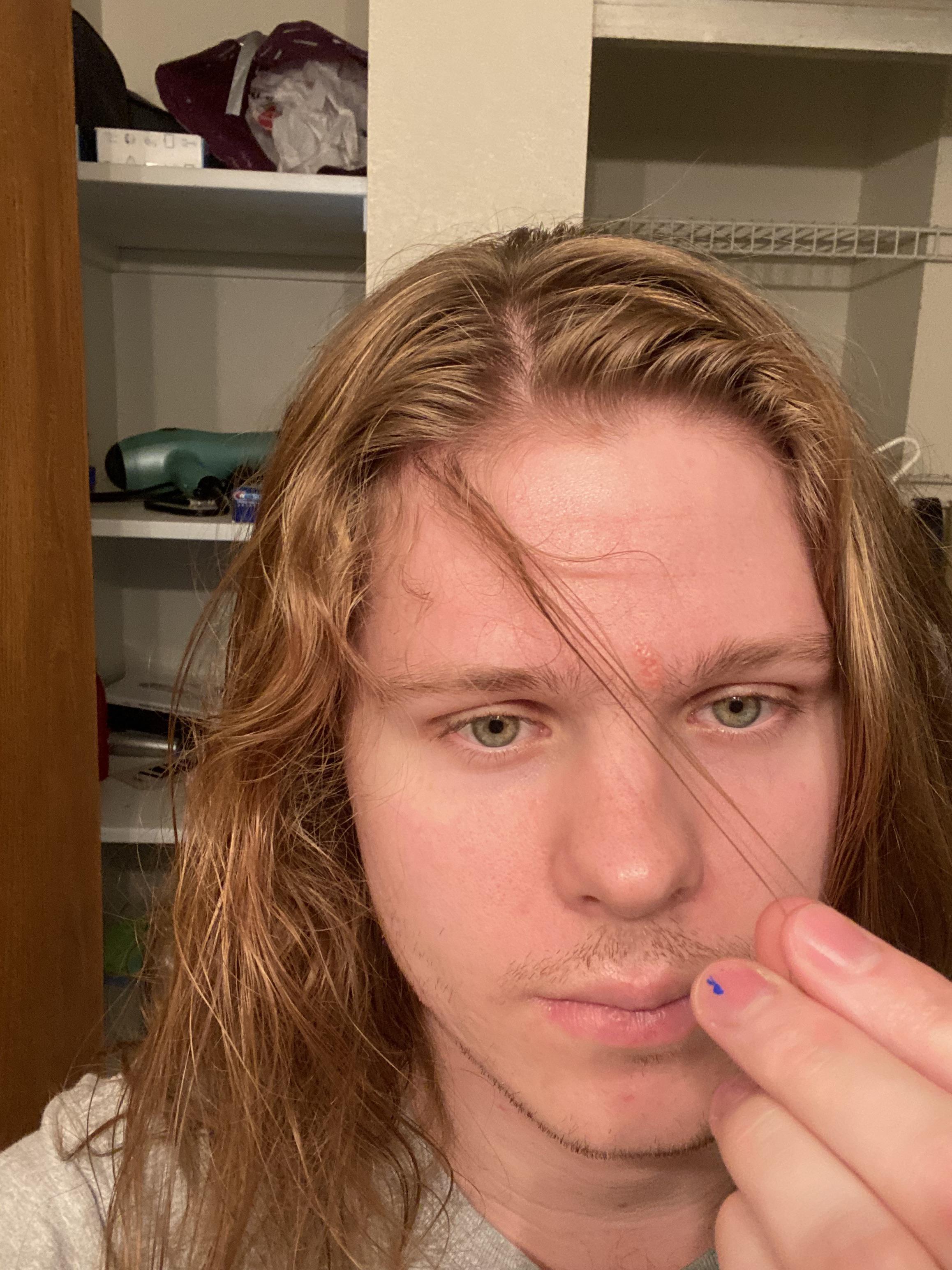 Details more than 81 baby hair forehead grow in.eteachers