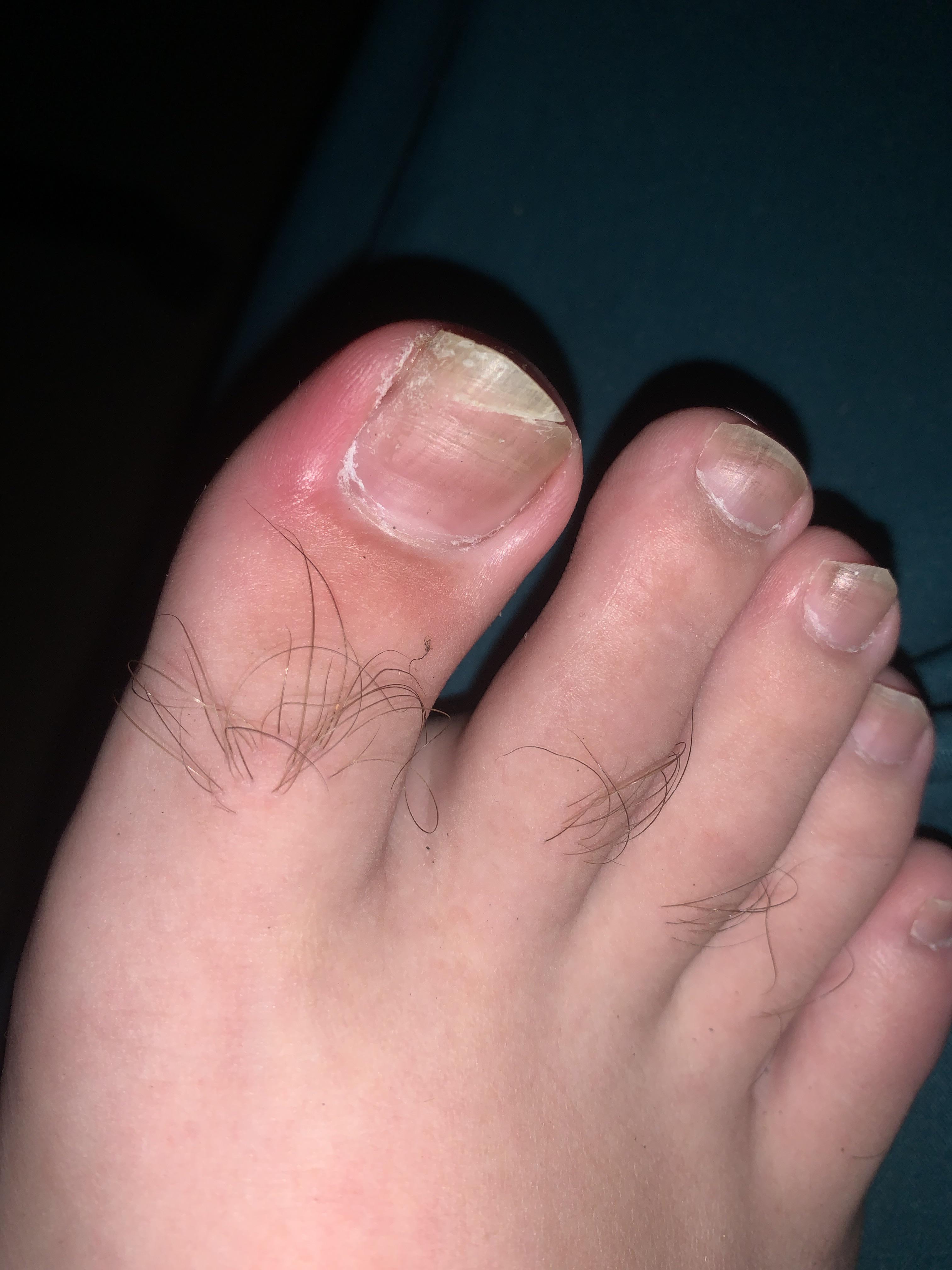 Toenail growing in weirdly after ingrown removal, anyone else