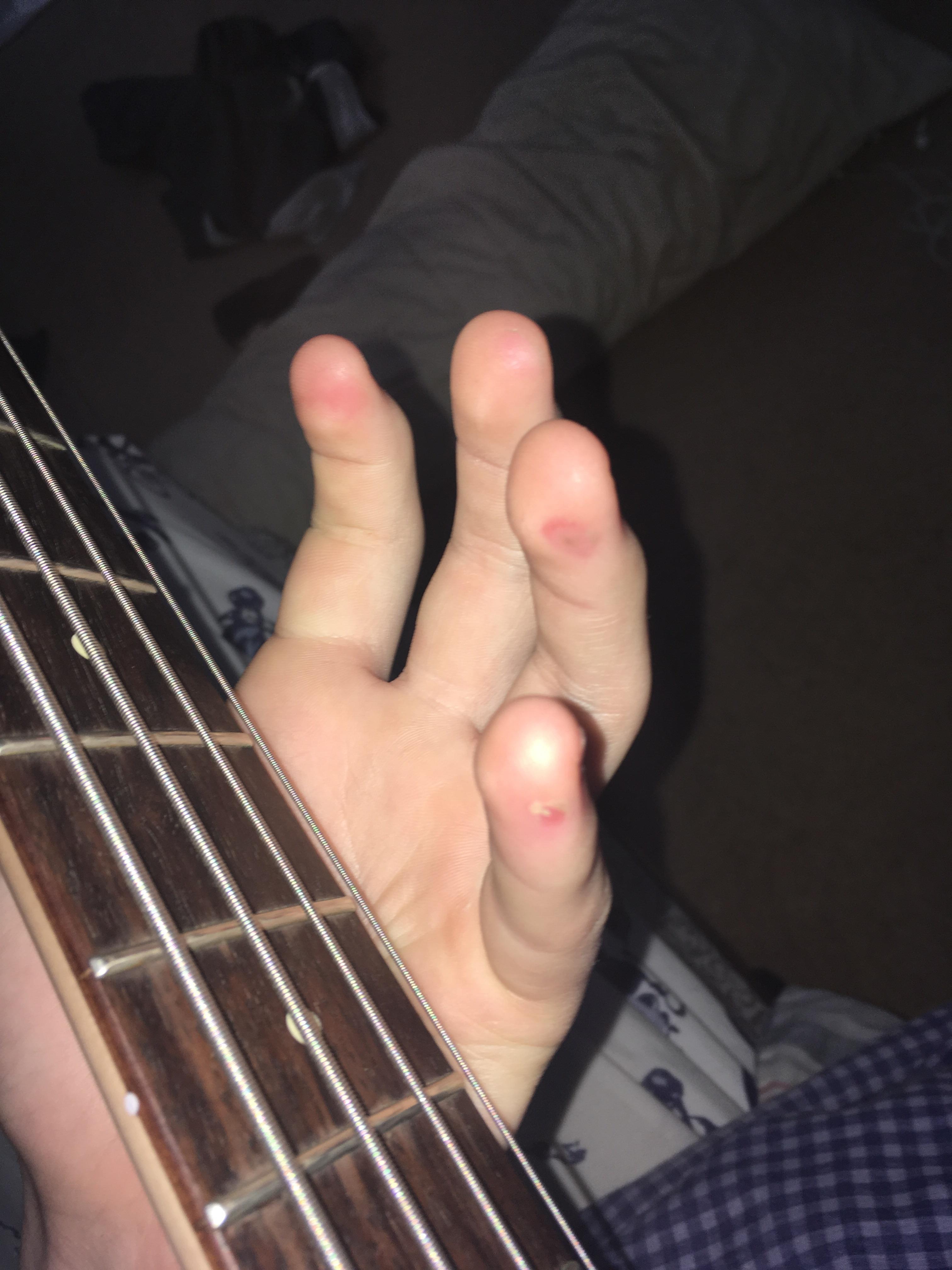 How much longer will I be getting these blisters on my hands from