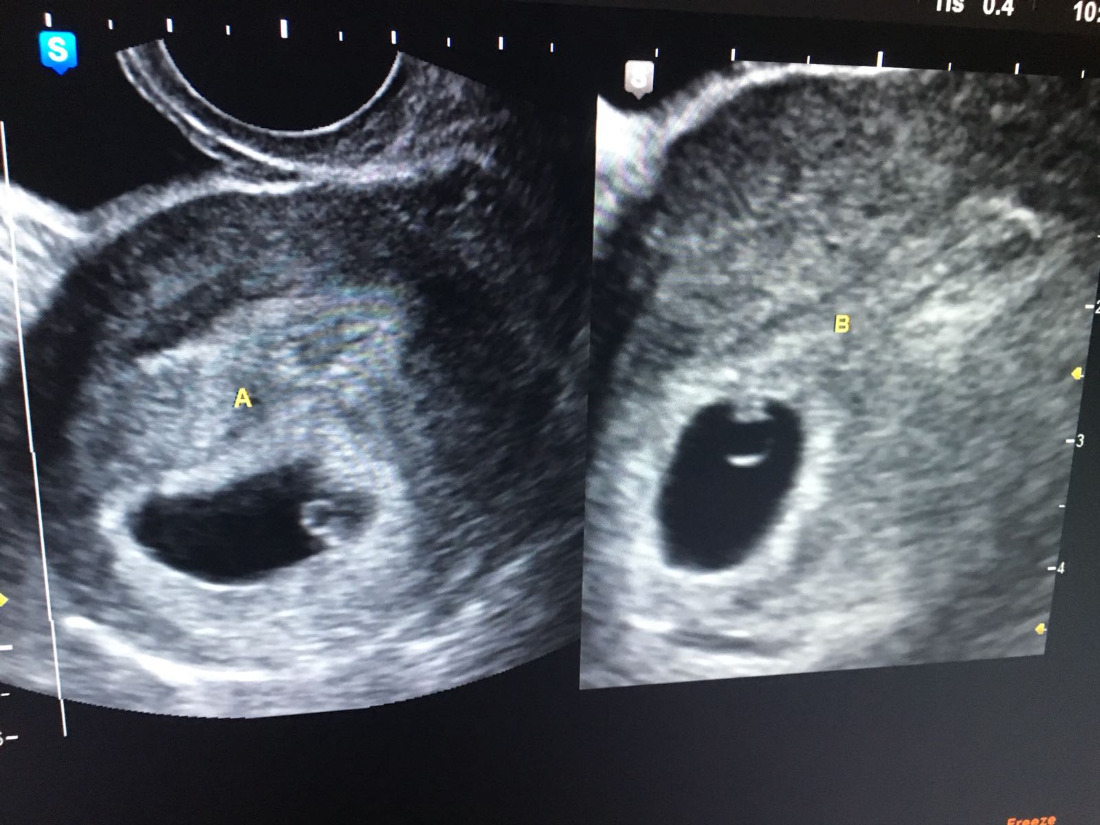 7 week ultrasound twins. ⛔ Twins at 6 Weeks What's Like