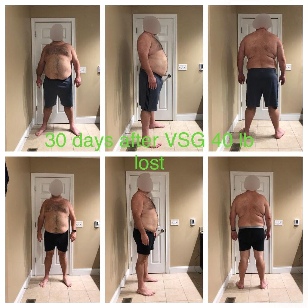 1 month after VSG down 43 lbs from surgery; 55 from HW r/wls