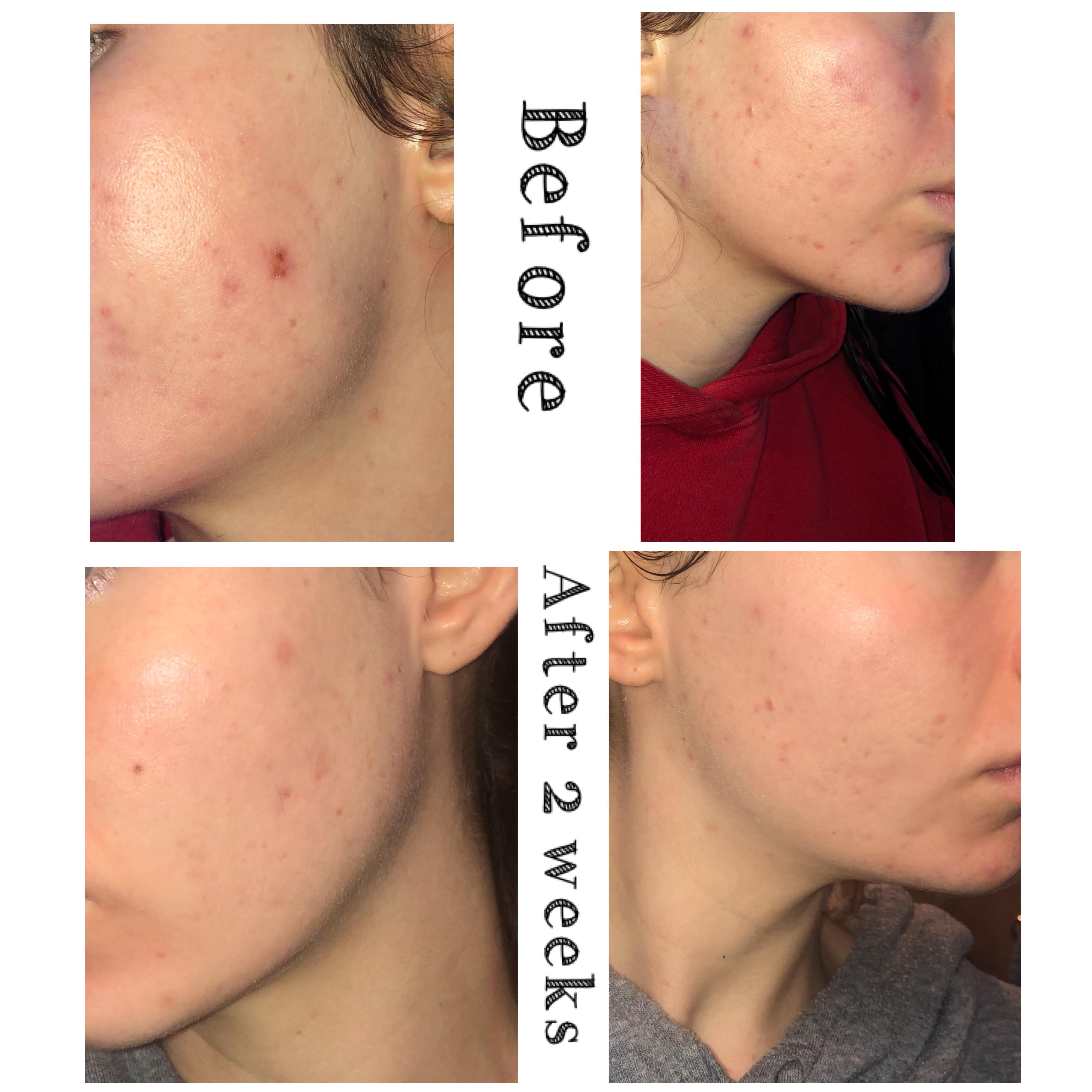 Two weeks of azelaic acid and tretinoin r/CanSkincare