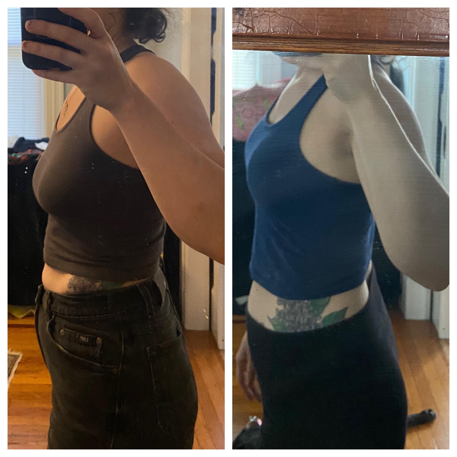 3dpo breast lift no implants r/PlasticSurgery