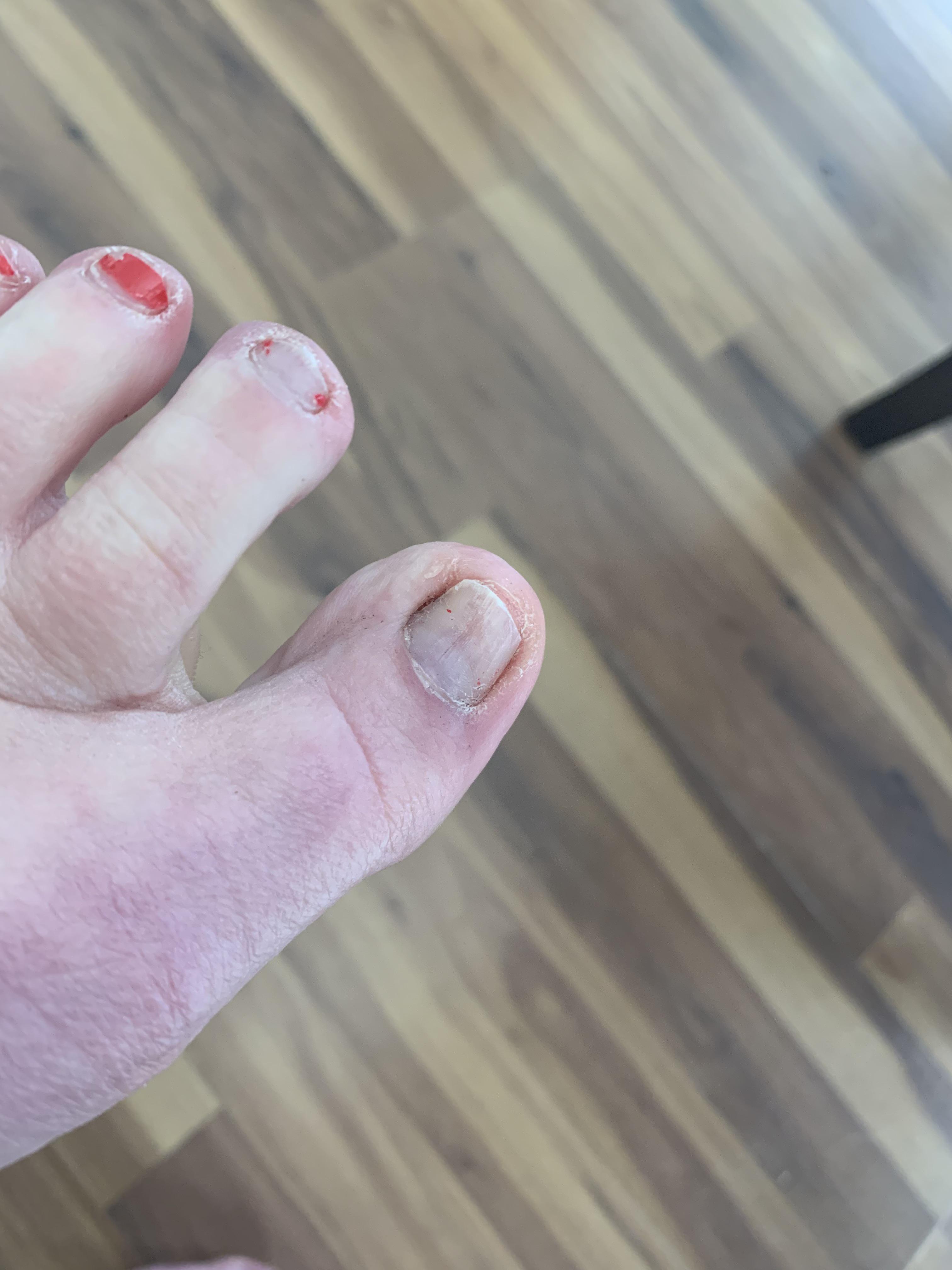 I had a partial chemical matrixectomy 6 months or so ago and the last few months my nail bed has