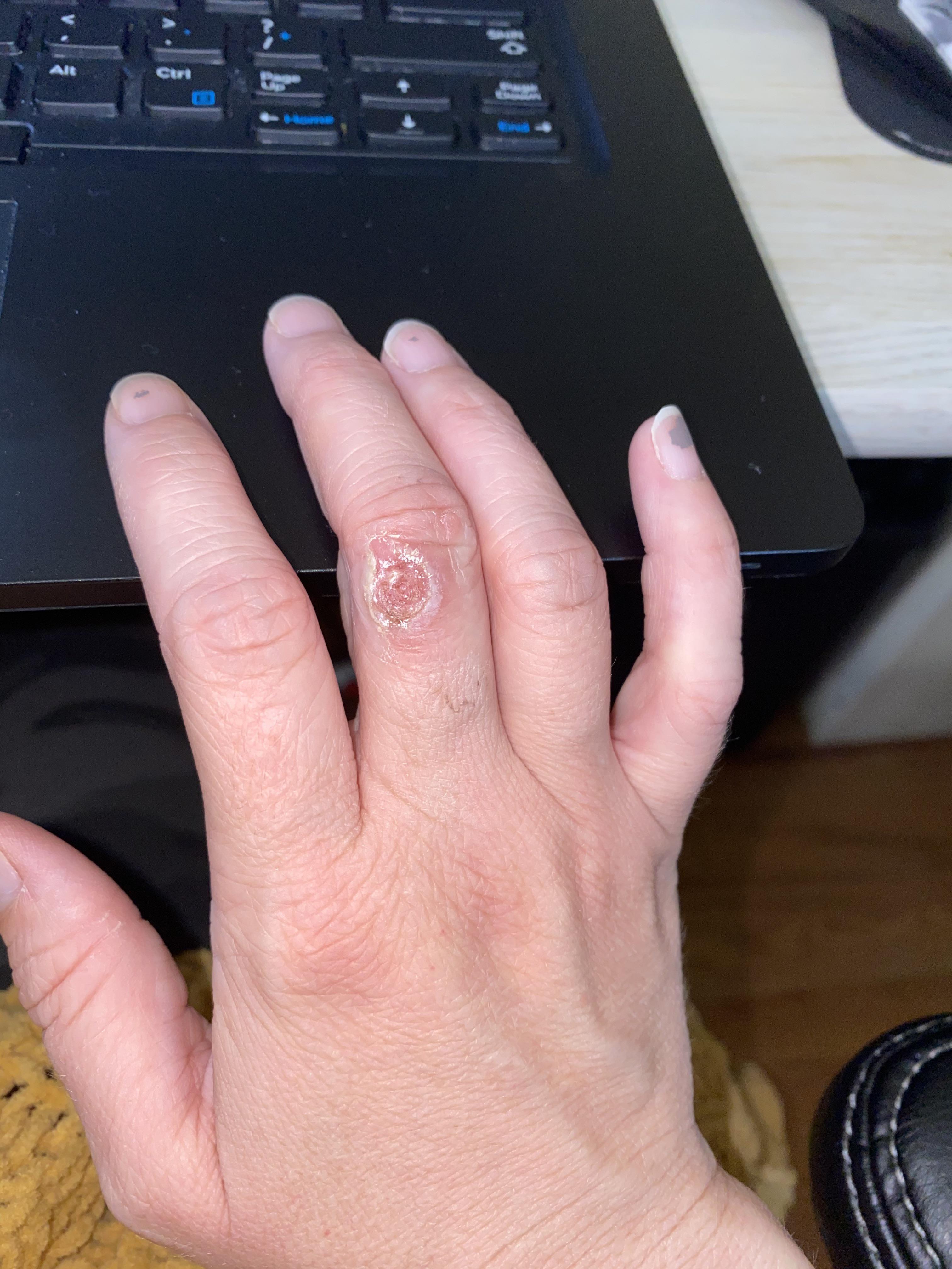 Zinc Oxide begins r/Warts