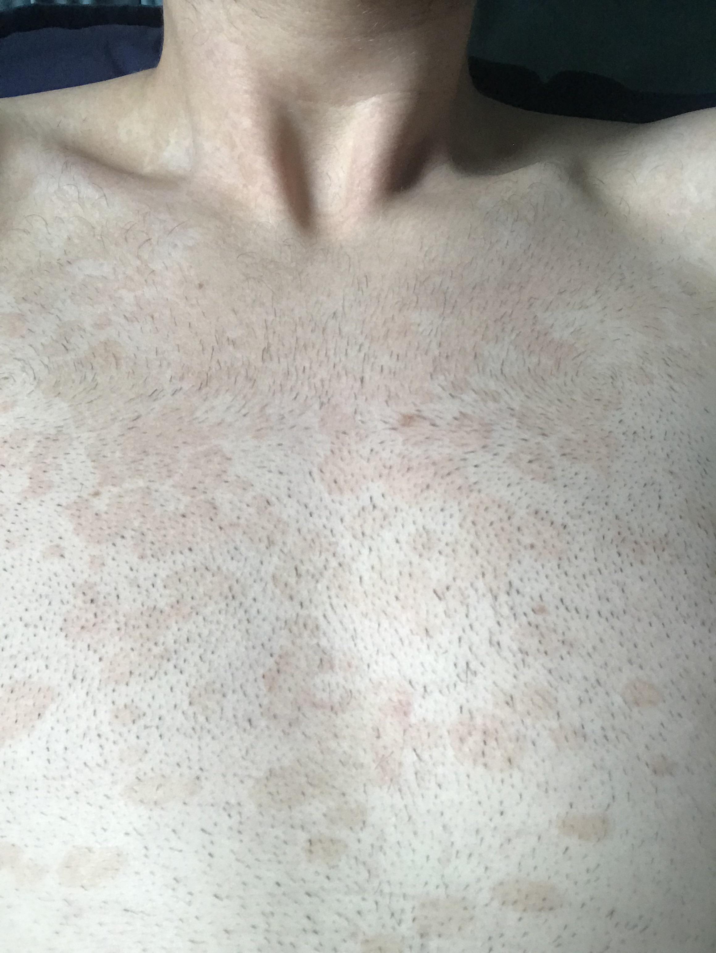 Pronounce Birthplace reality red spots on chest and shoulders parade