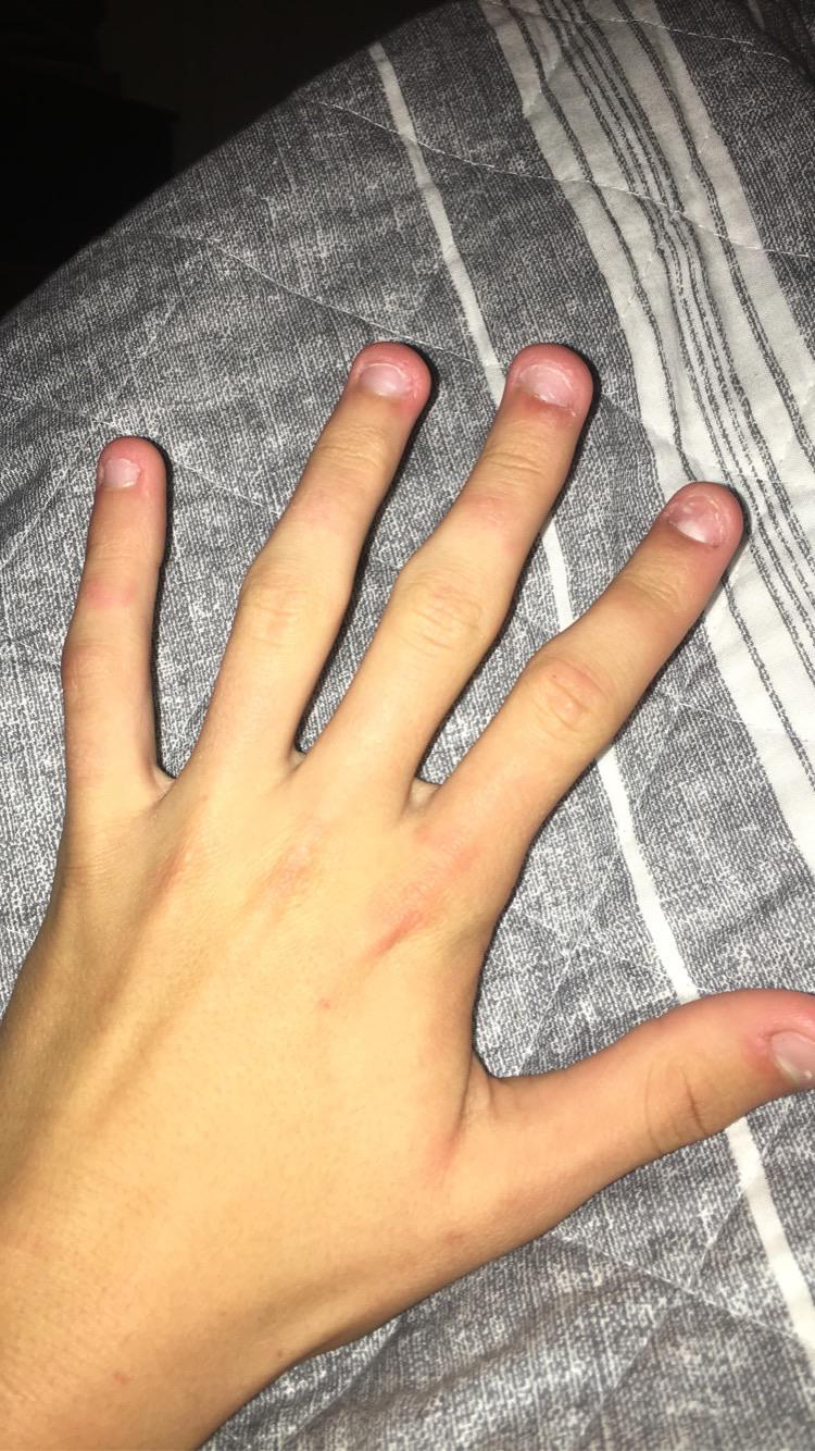 any way to fix this or is irreversible? tips of fingers look like stubs