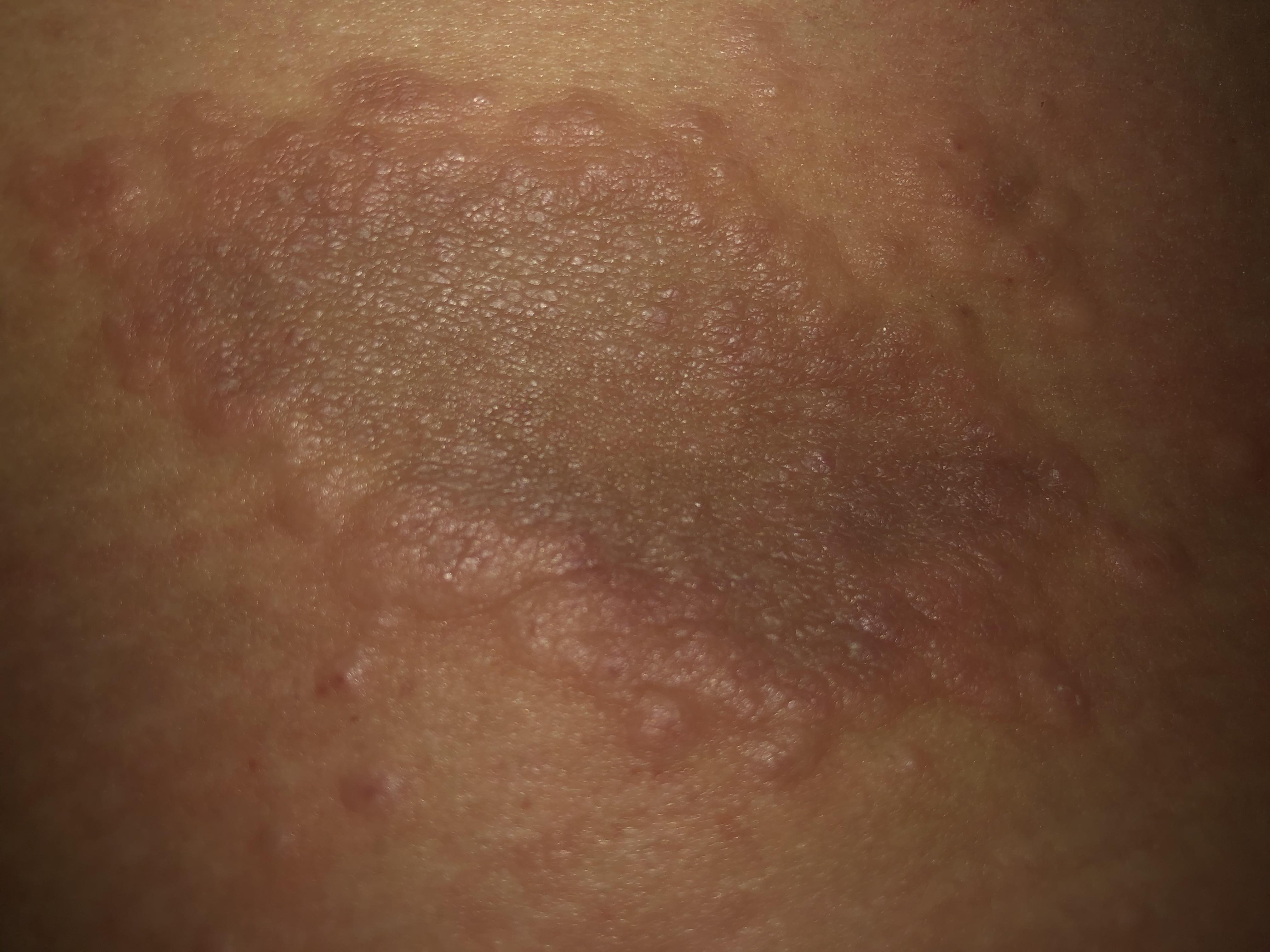 Does anyone know what kind of rash this is? It’s on the right side of