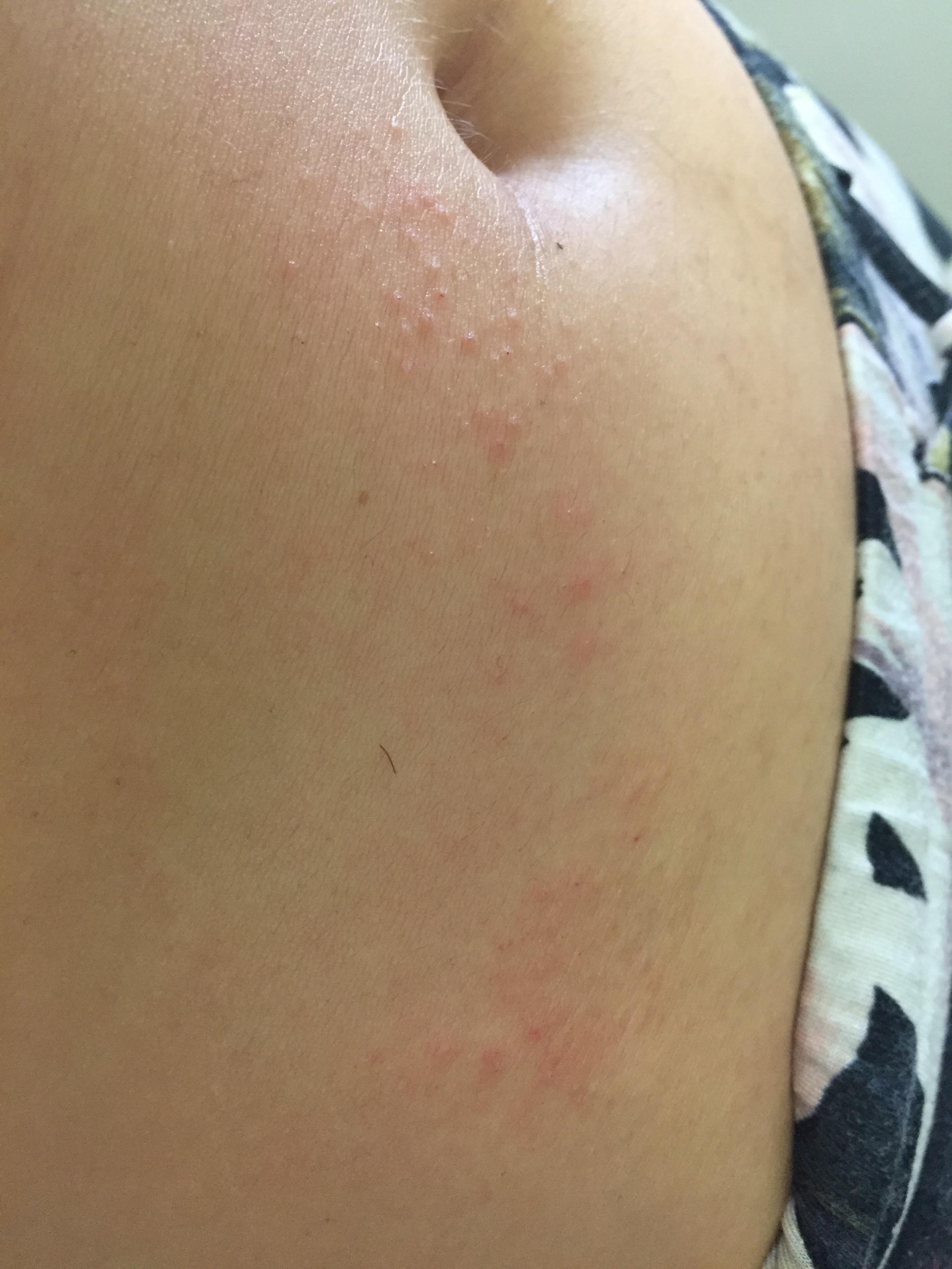Is this follicular eczema or fungal related? r/DermatologyQuestions
