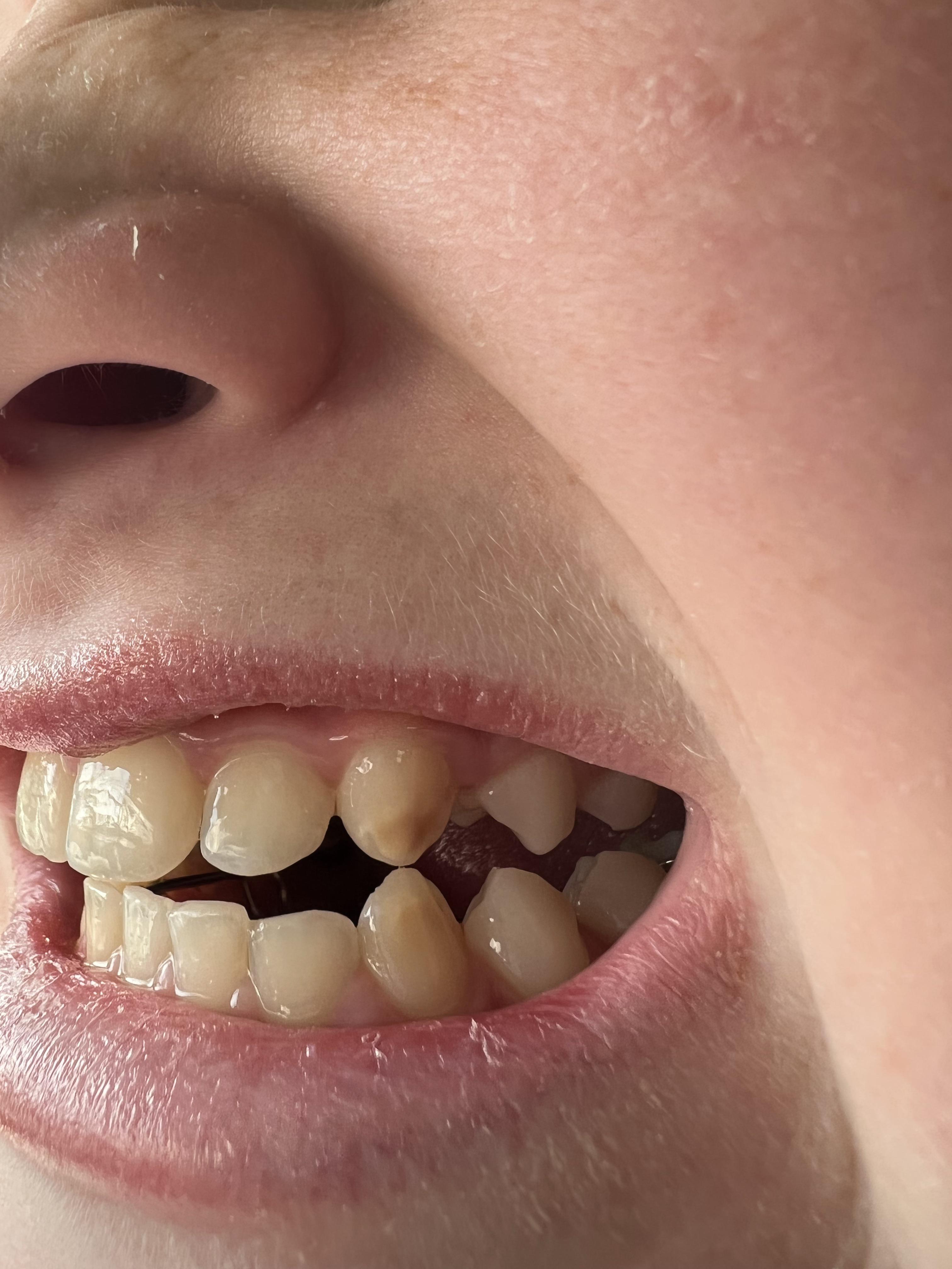 Discolored teeth in 12 year old with celiac. Is it a cause of celiacs