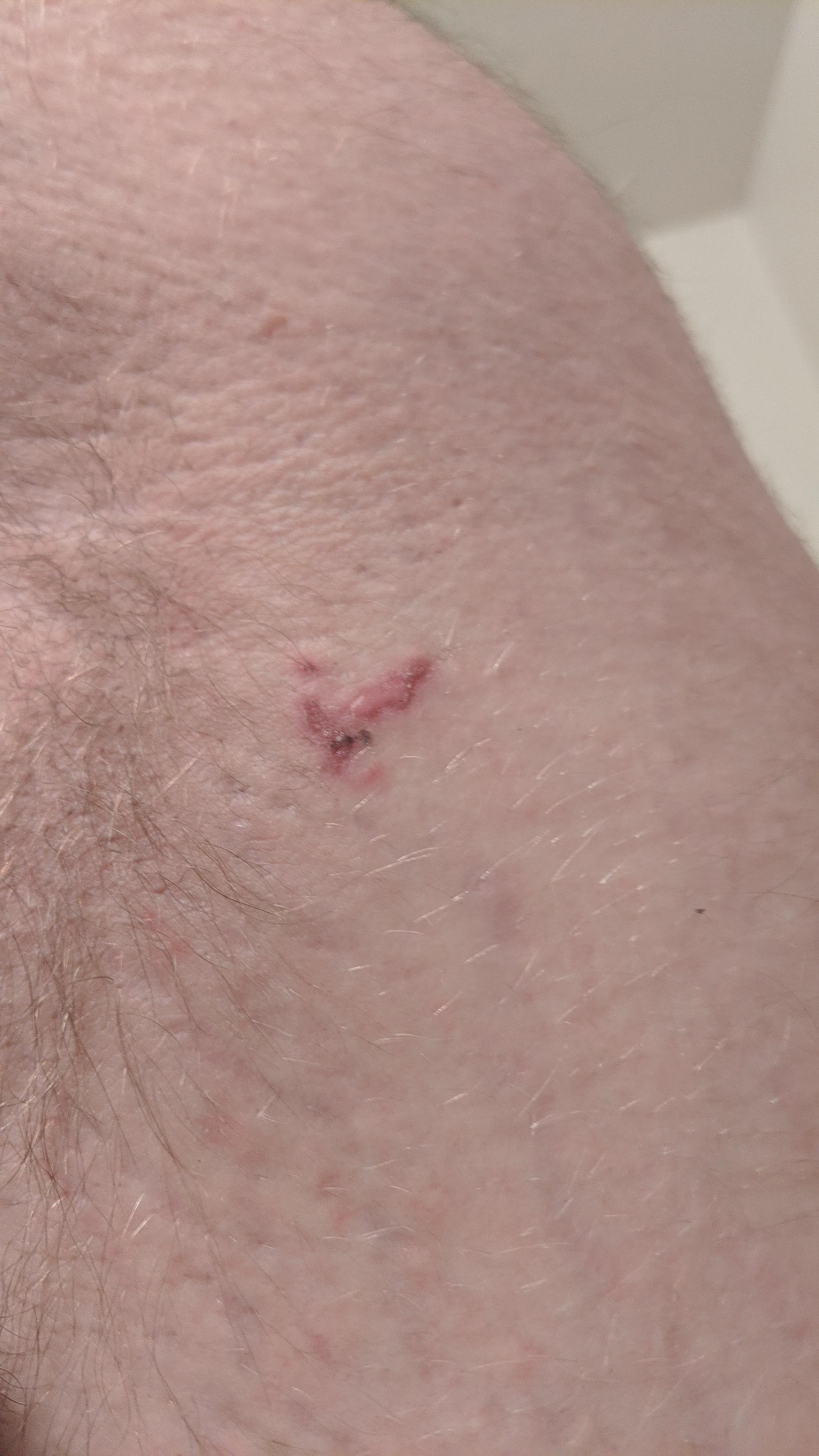 This weird cut with a black mark on it is under my armpit. I have a lot