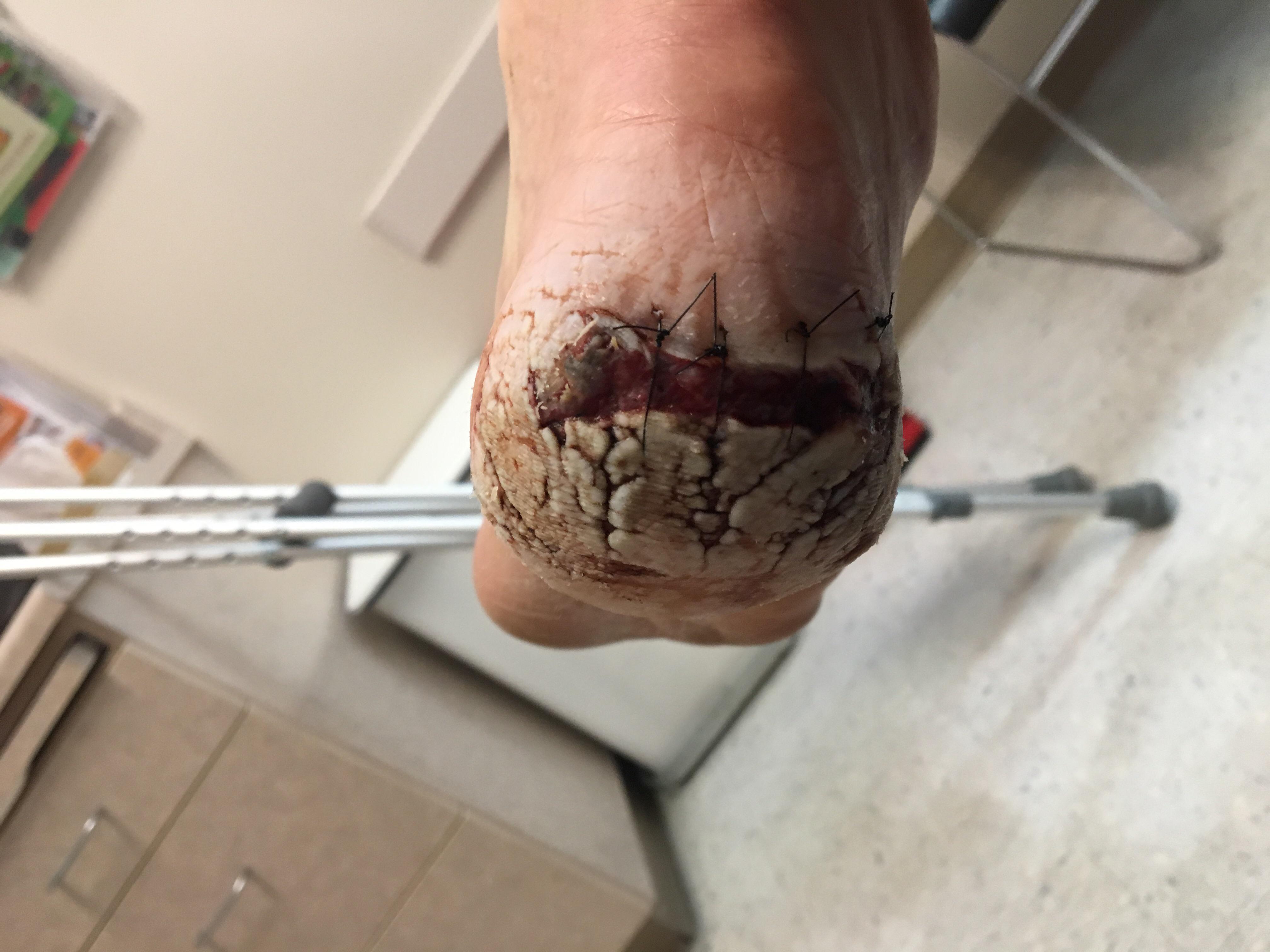 The gunshot wound from my last post 5 days after the