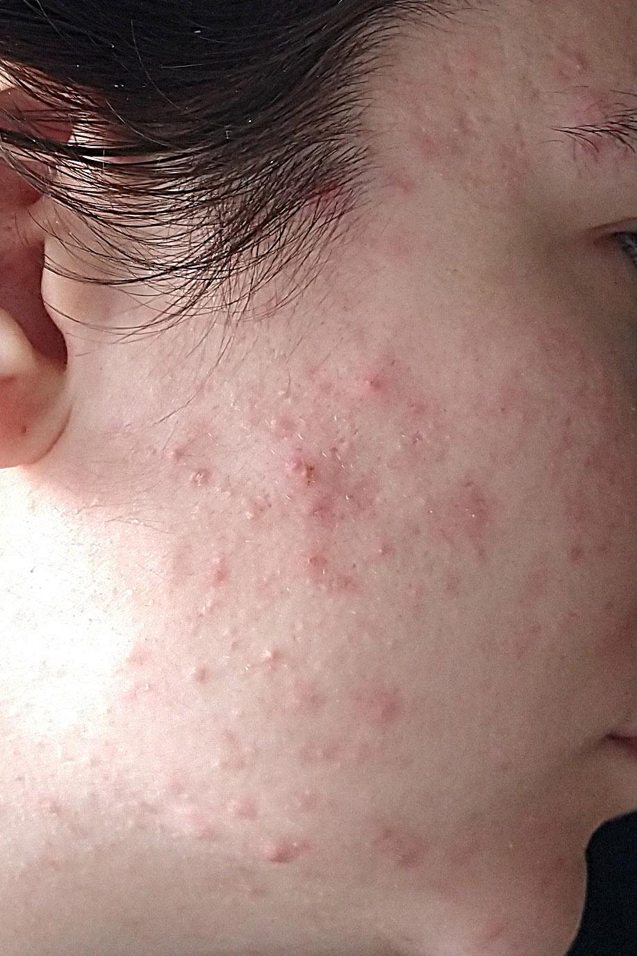 Adult Acne Causes And How To Get Rid Of It, Say Dermatologists lupon
