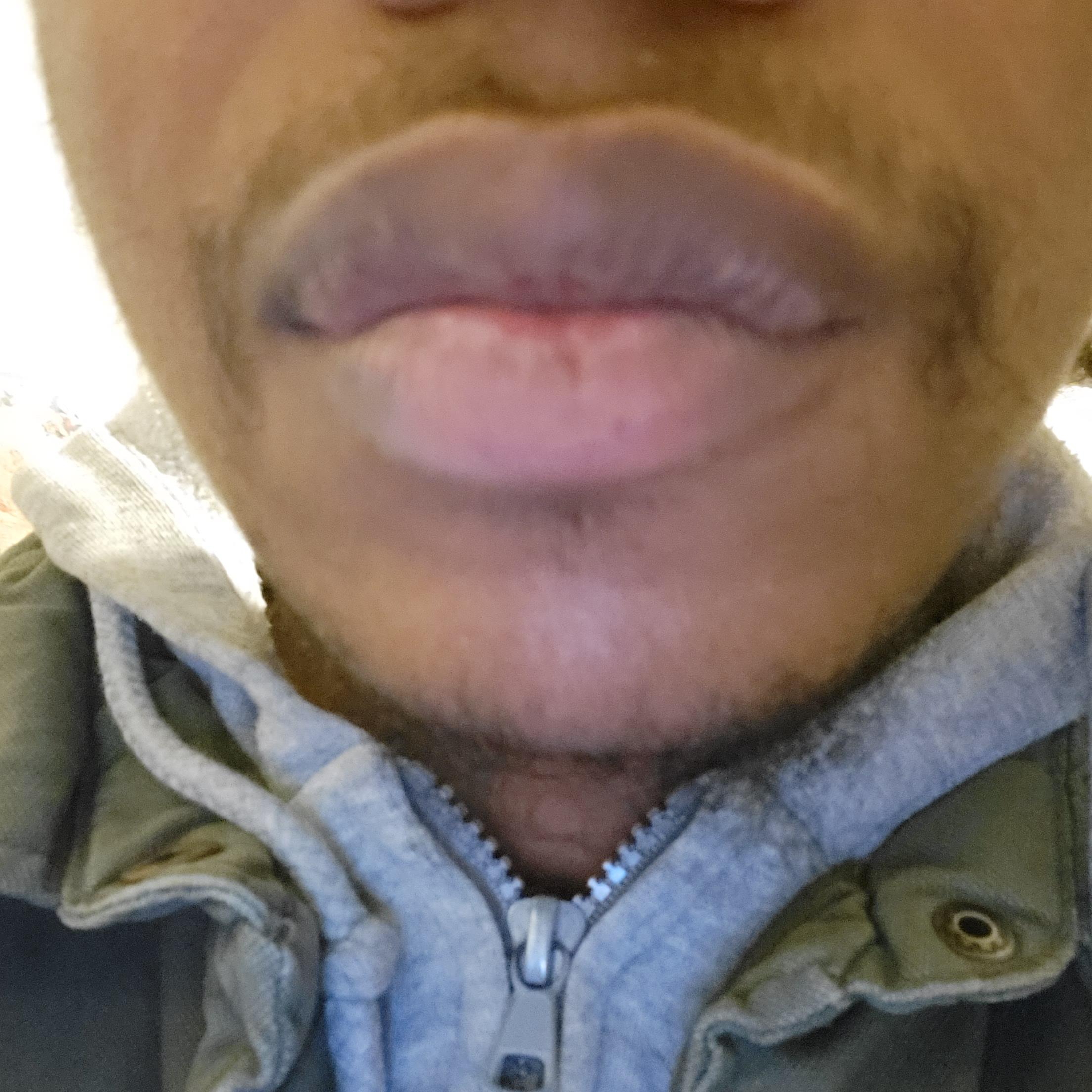 [Product Question] Lips discolored. Best fix and care routine? r