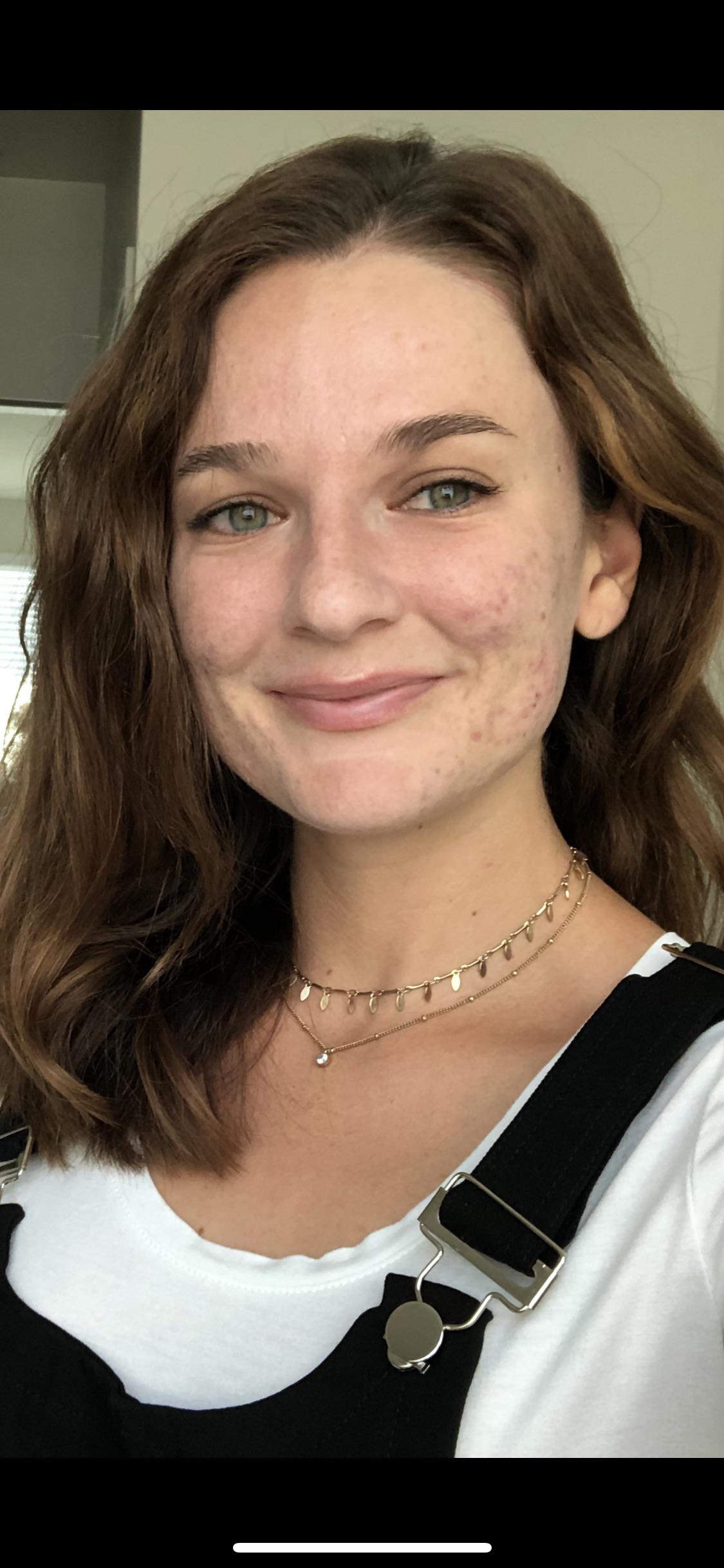 Accutane side effect Accutane