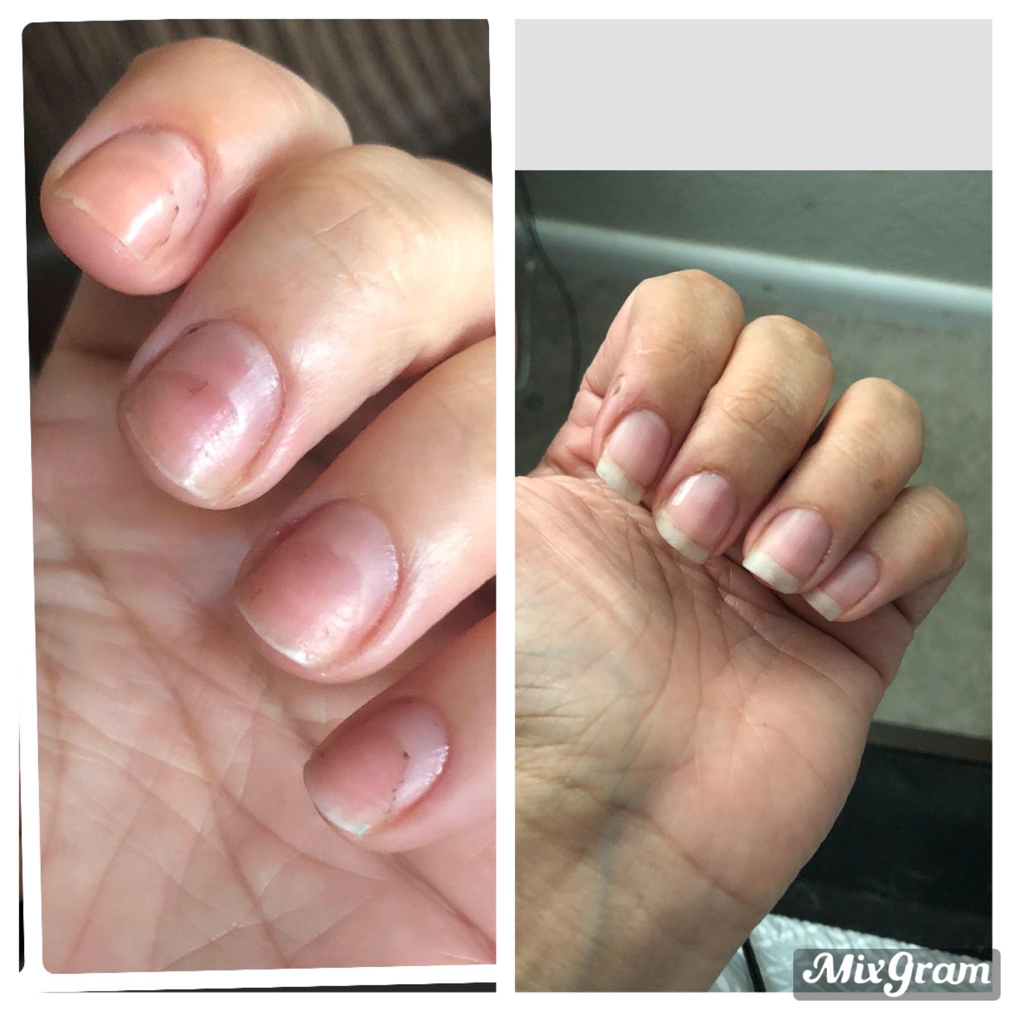 90 day progress pic. Acrylic damage finally outgrown r/nailbiting