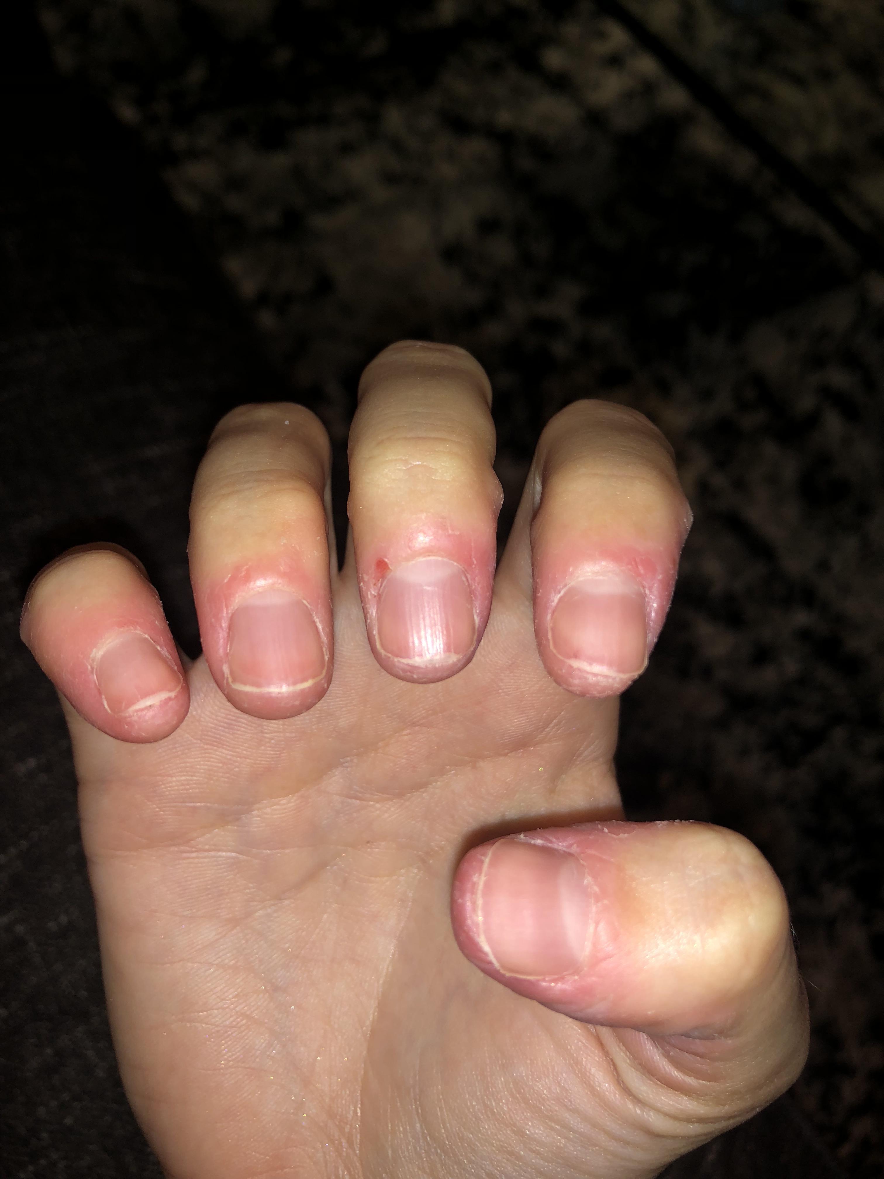 I relapsed to biting my nails and the skin again. My biggest problem is