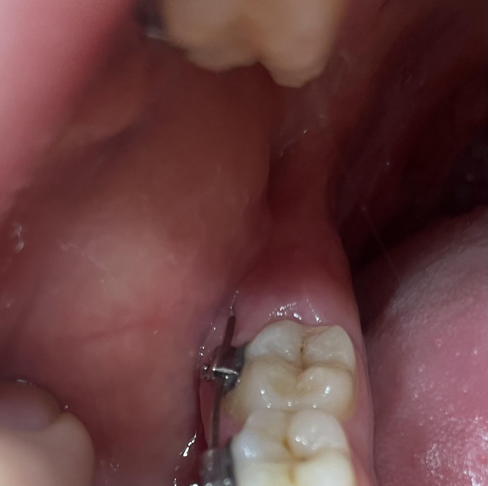braces wire embedded in gums.. what do i do? r/braces