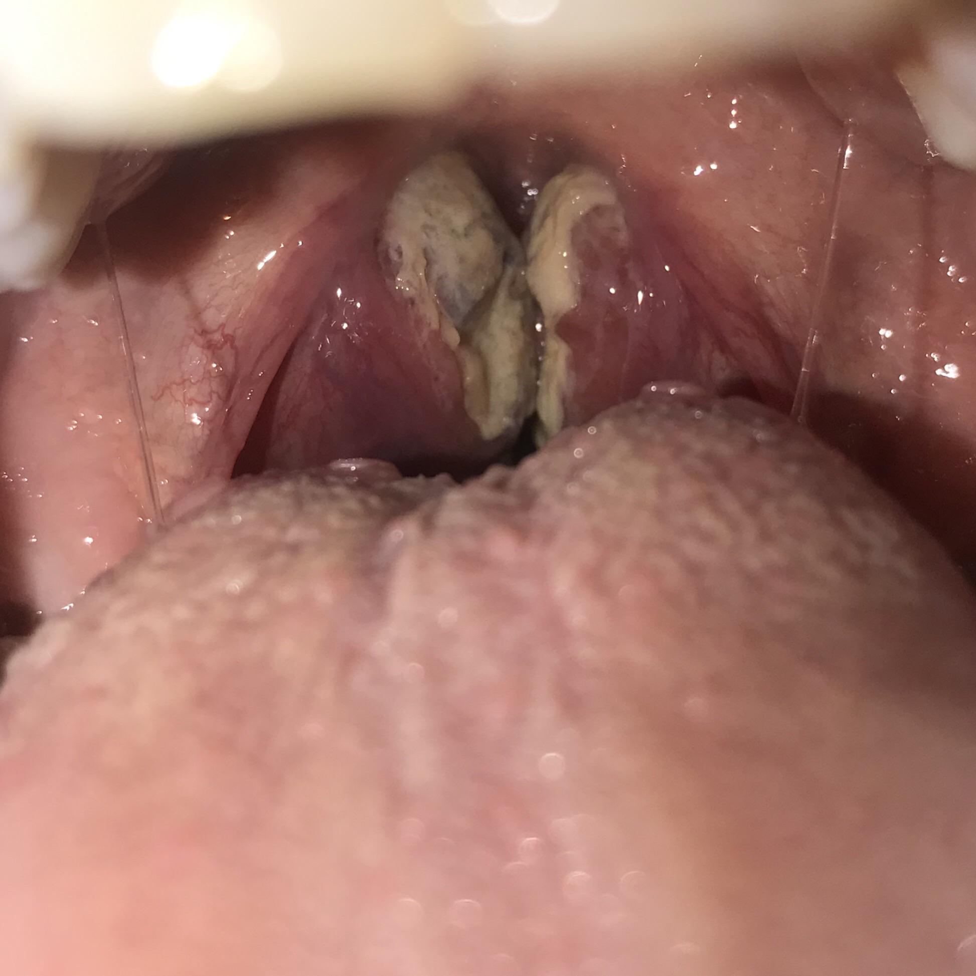 As bad as my tonsils got with strep throat colonizing in