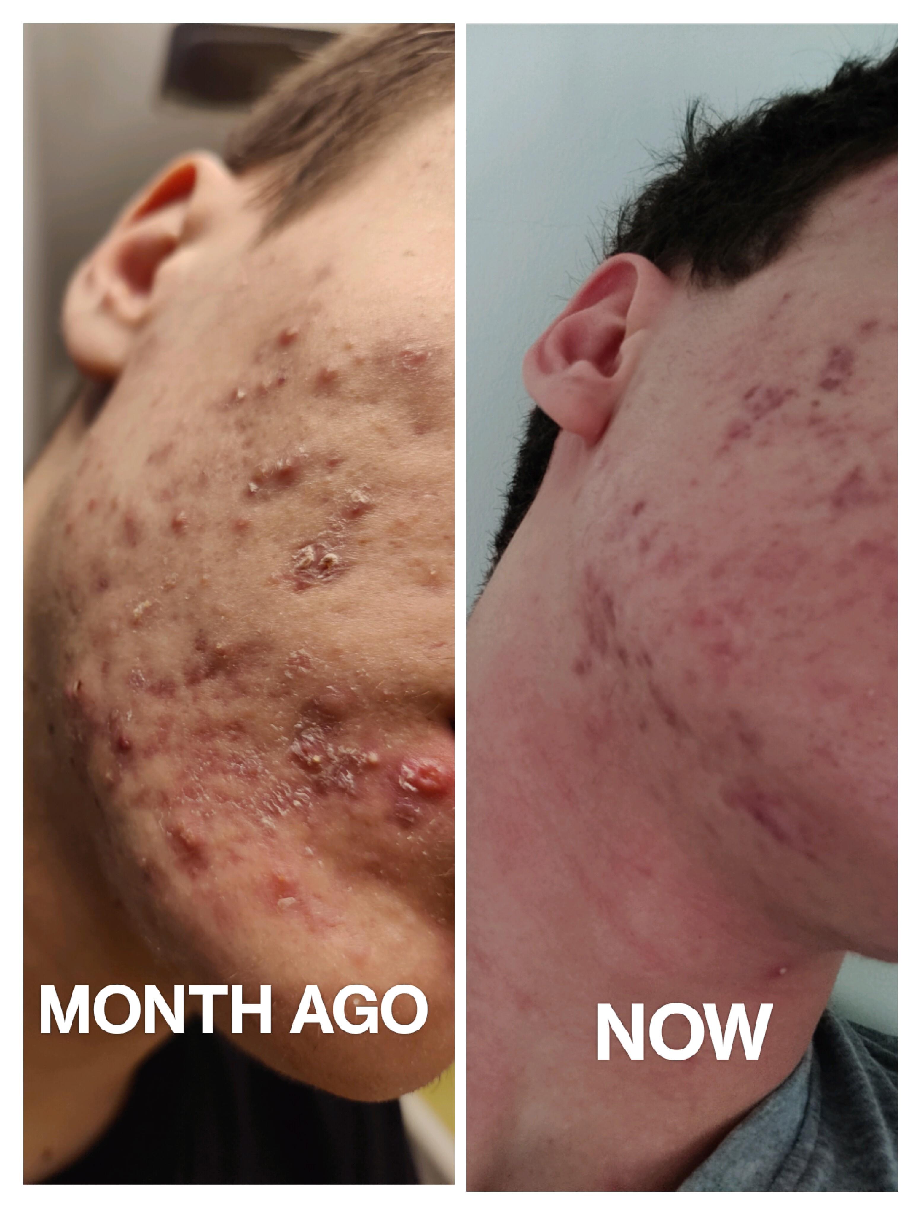 my acne are slowly disappearing, but now I have a problem how to get