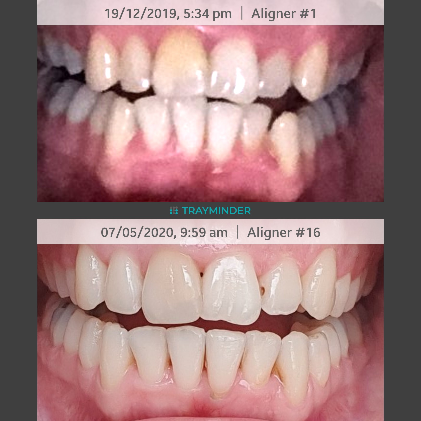 Month 6 Week 1! Only 2 more aligners to go 😄