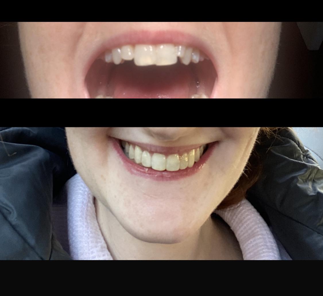 5 months rapid braces. Still need to whiten and then adjust the bonding. ( previously had braces