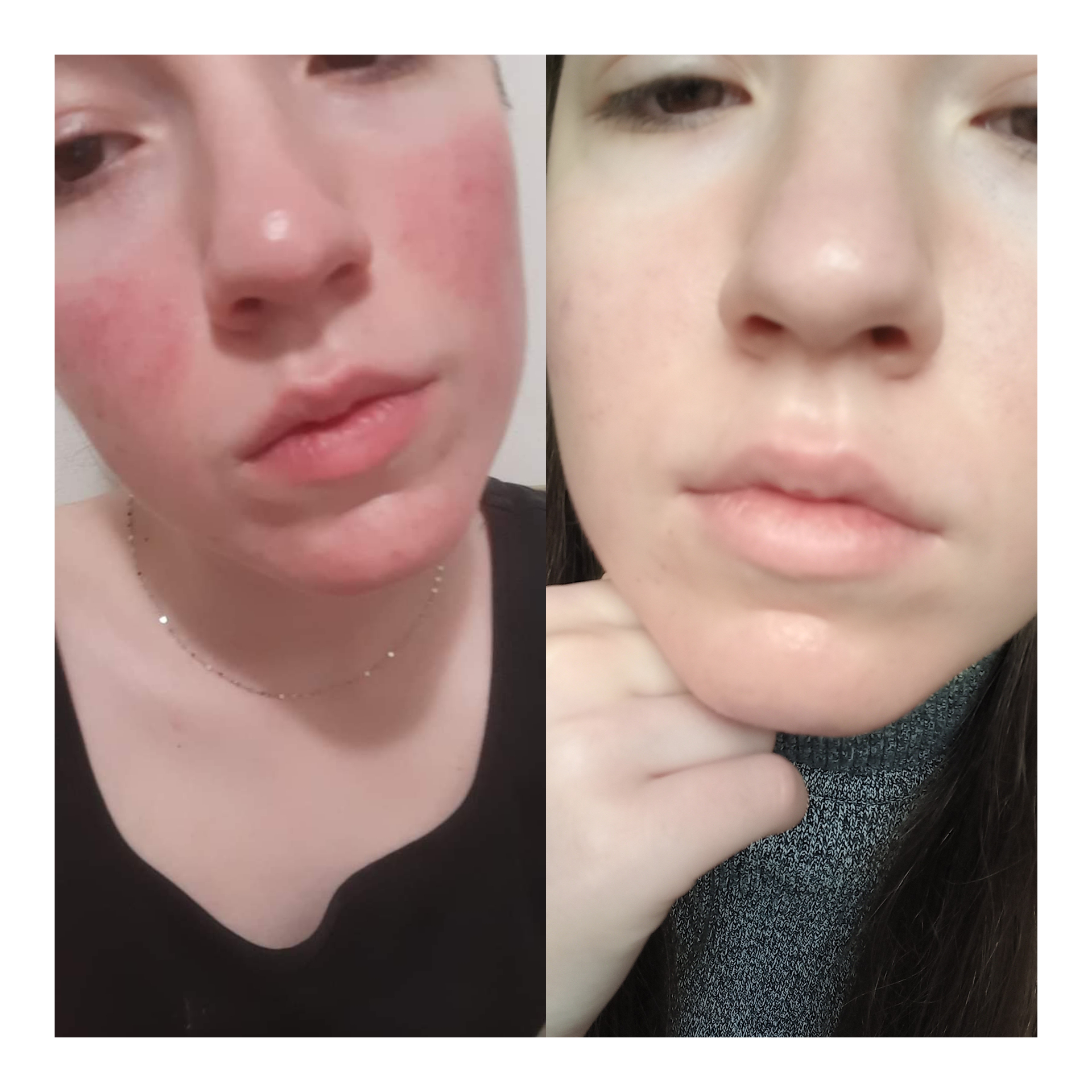 Vbeam progress papulopustular rosacea r/Rosacea