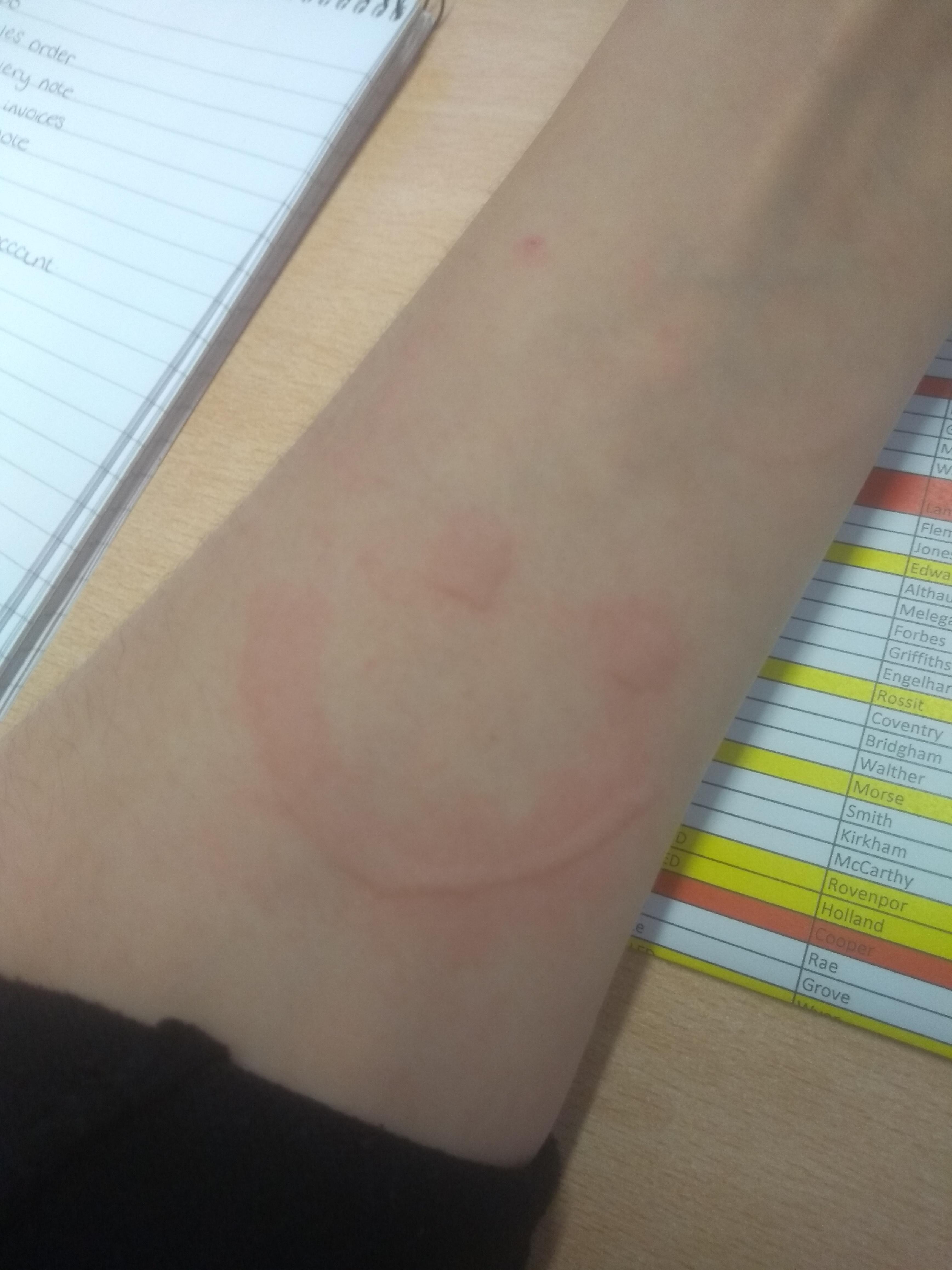 When your hives flare up on a slow day at work, you have to make it fun